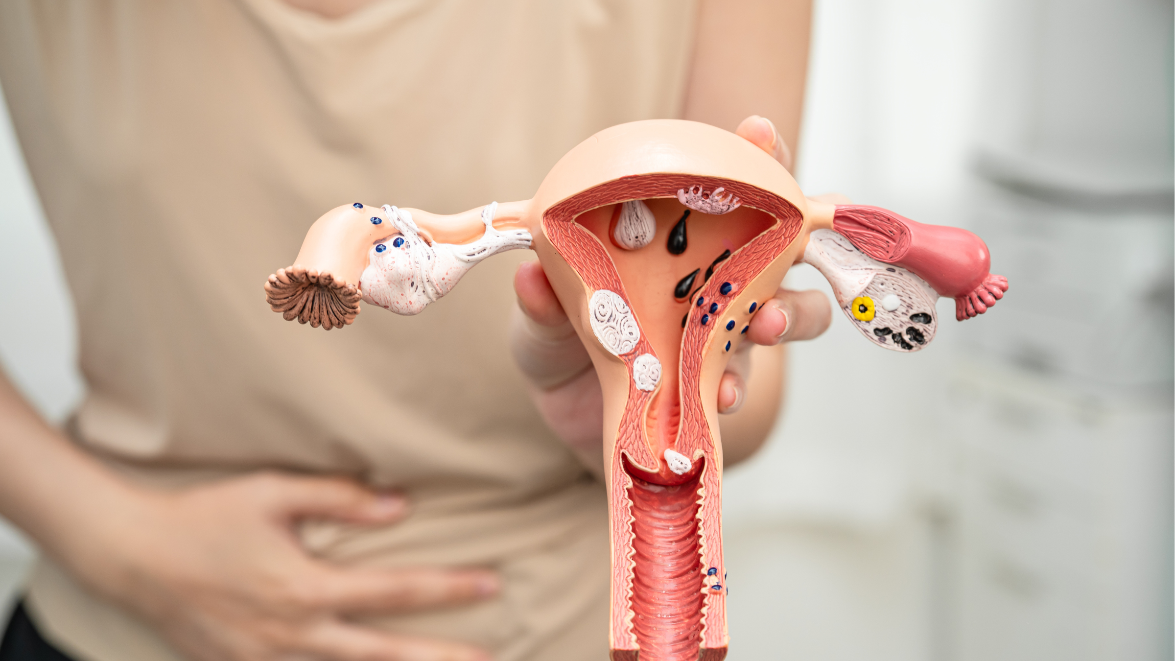 Nếu không được điều trị, viêm lộ tuyến có thể tiến triển sang độ 3