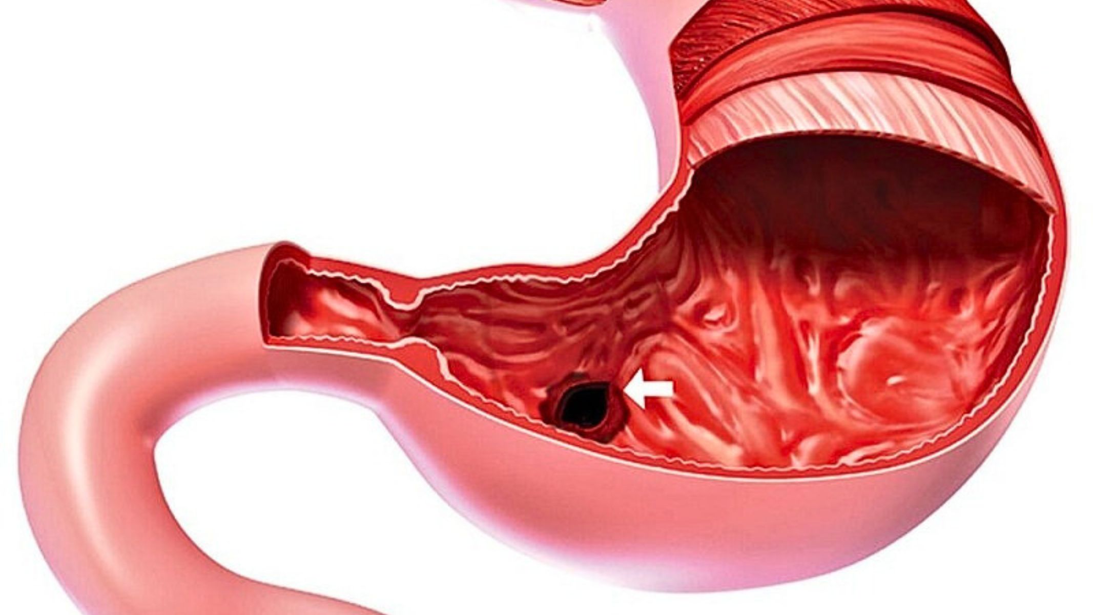 Hẹp môn vị là hậu quả của xơ teo mô do loét lâu ngày, khiến thức ăn khó di chuyển xuống ruột non