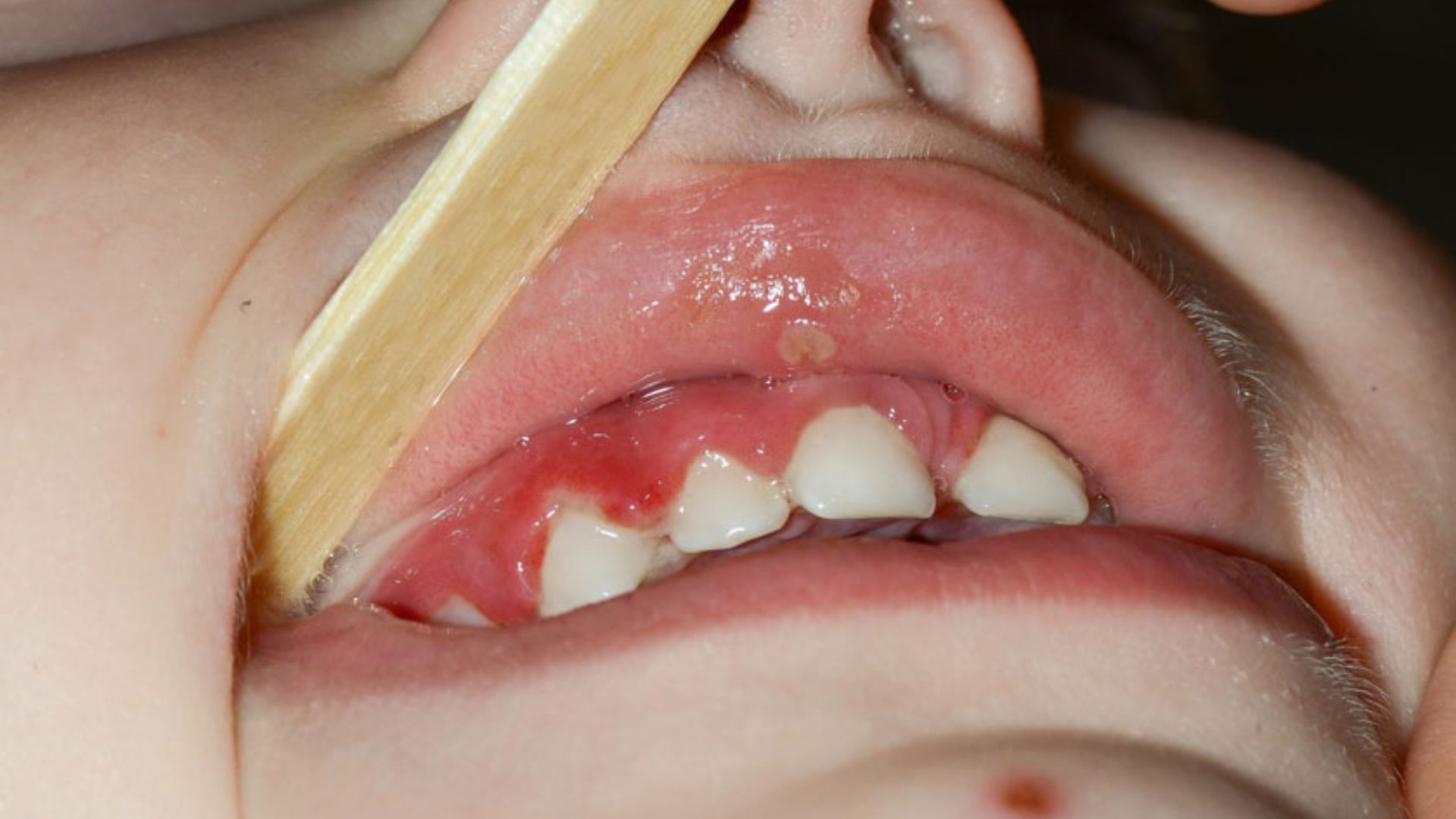 Lợi sưng đỏ và dễ chảy máu là dấu hiệu nhận biết tình trạng viêm lợi ở trẻ em