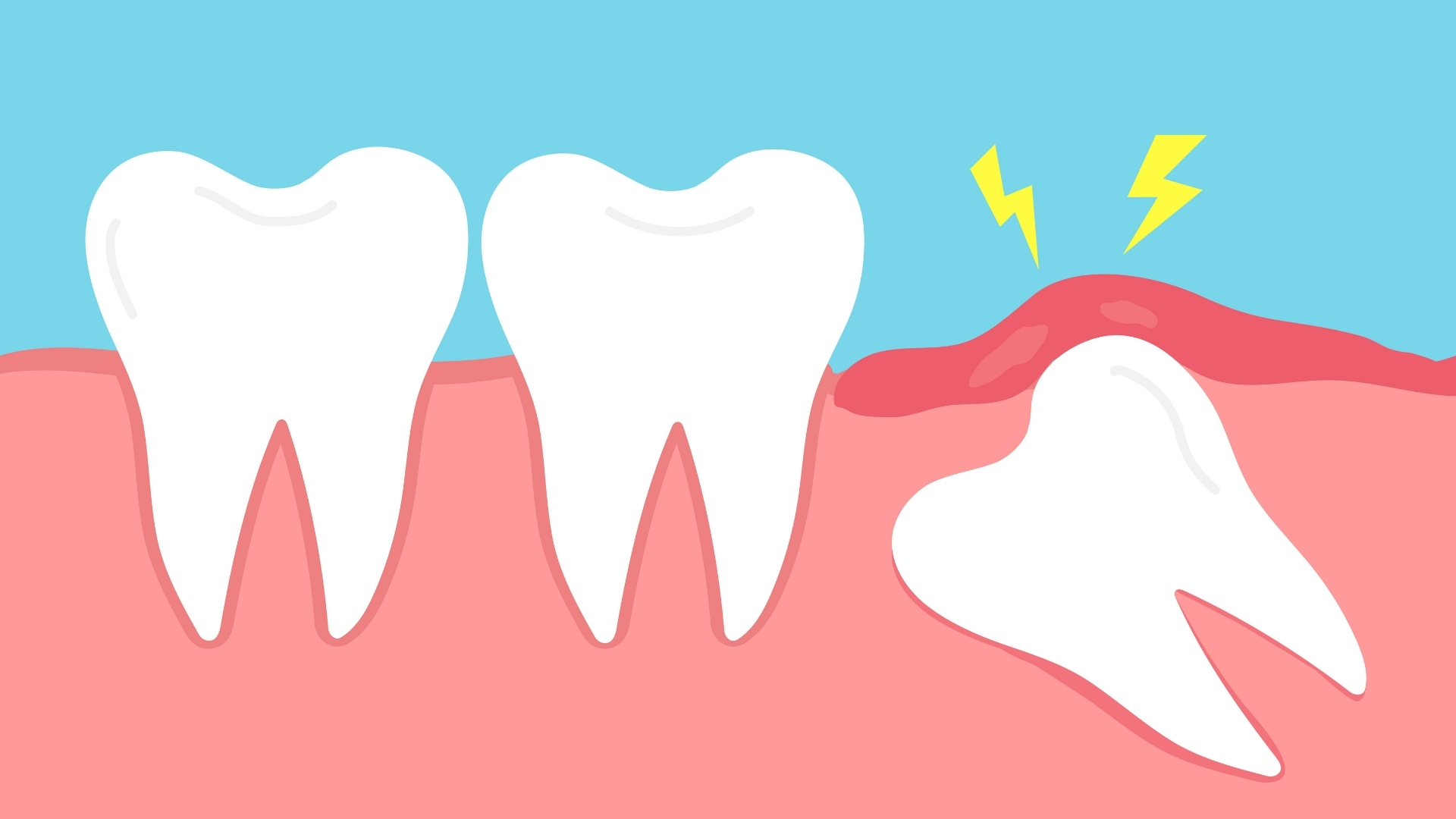 Viêm lợi trùm là tình trạng phần mô nướu (lợi) bao phủ một phần răng (thường gặp nhất ở răng khôn) bị viêm do vi khuẩn tích tụ dưới lớp lợi này