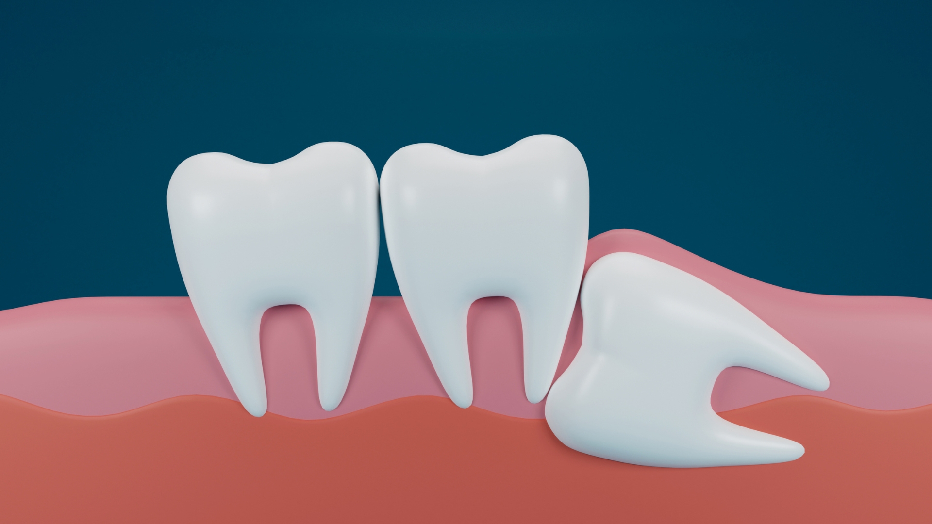 Răng khôn mọc lệch, mọc ngầm hoặc mọc dở dang có thể gây viêm lợi trùm