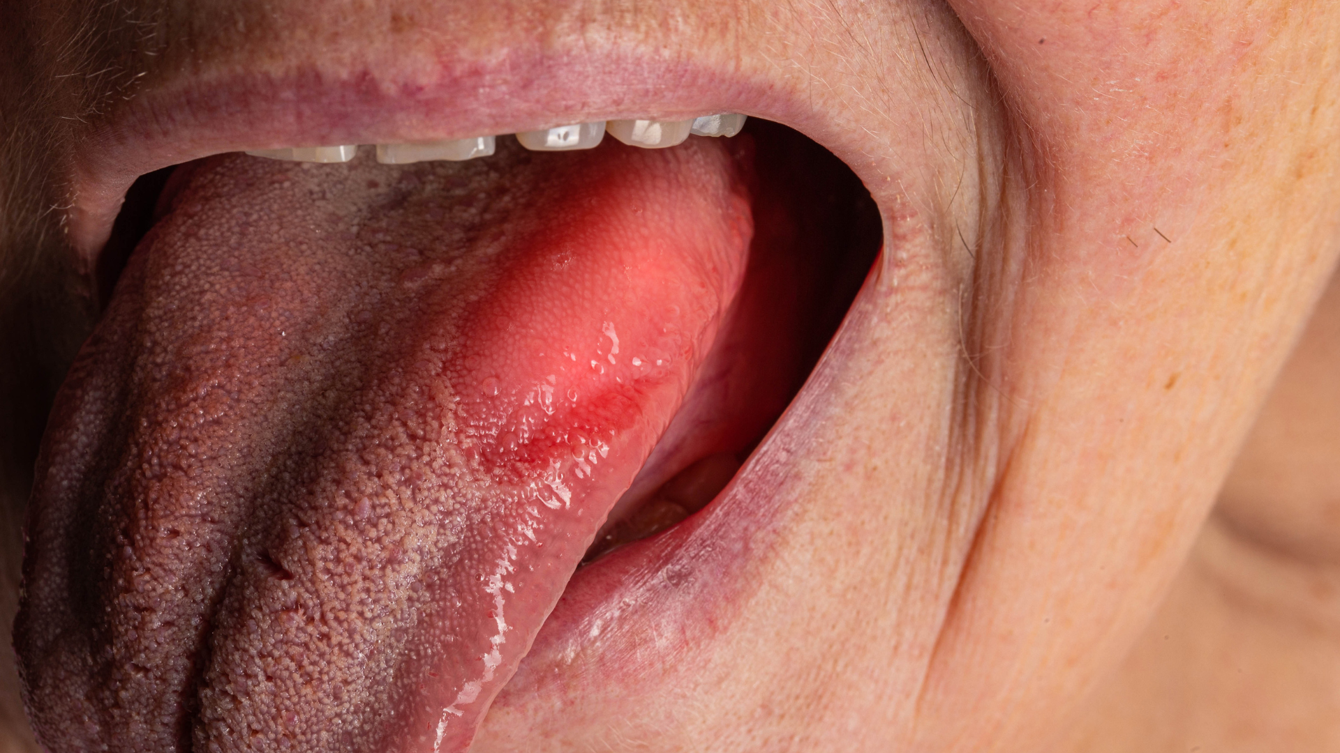 Bệnh nhân đái tháo đường có nguy cơ mắc viêm lưỡi