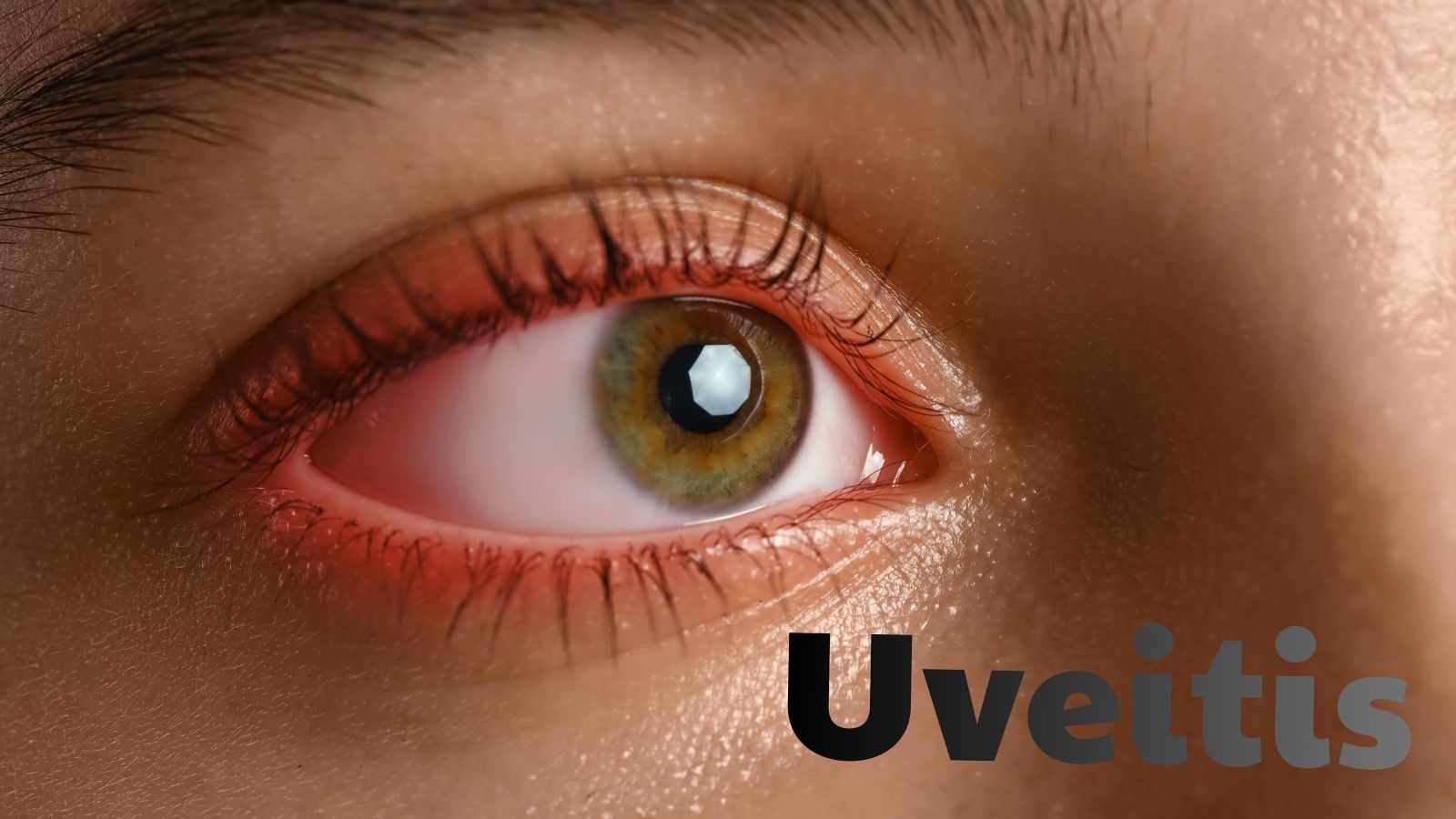 Nguyên nhân gây viêm màng bồ đào rất đa dạng, có thể liên quan đến nhiễm trùng, bệnh lý tự miễn,...