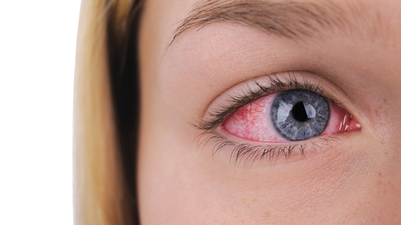 Viêm màng bồ đào khiến thị lực suy giảm, nhìn mờ, chói mắt hoặc đau nhức mắt