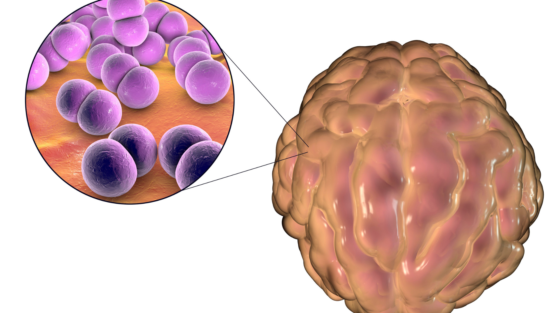 Khả năng điều trị viêm màng não mô cầu ở trẻ phụ thuộc nhiều yếu tố