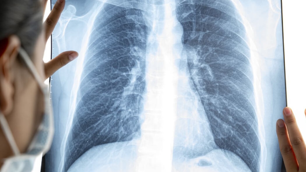 Xét nghiệm hình ảnh giúp xác định nguyên nhân gây viêm màng phổi