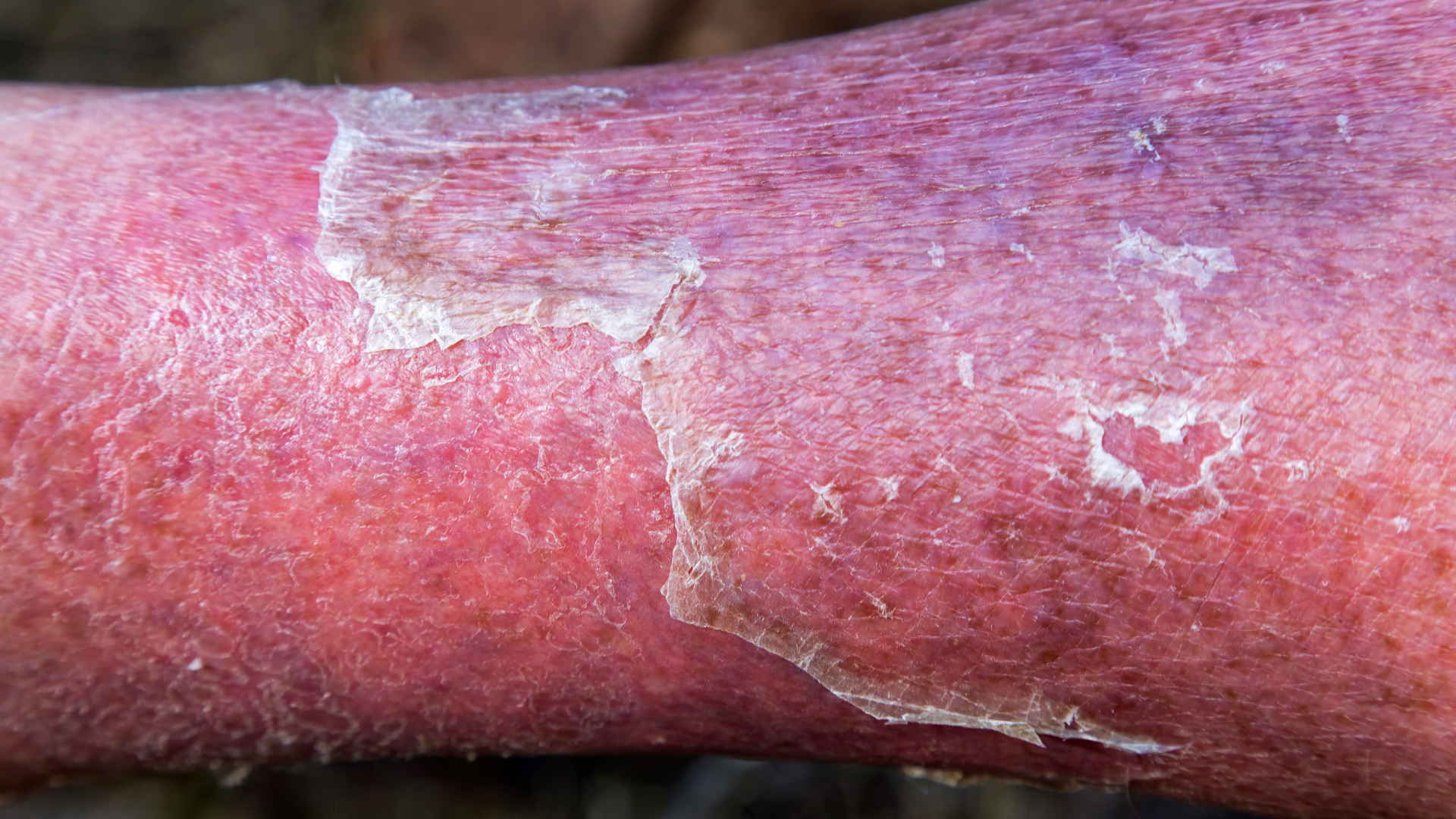 Viêm mô tế bào tại một vùng da có thể đi kèm triệu chứng toàn thân