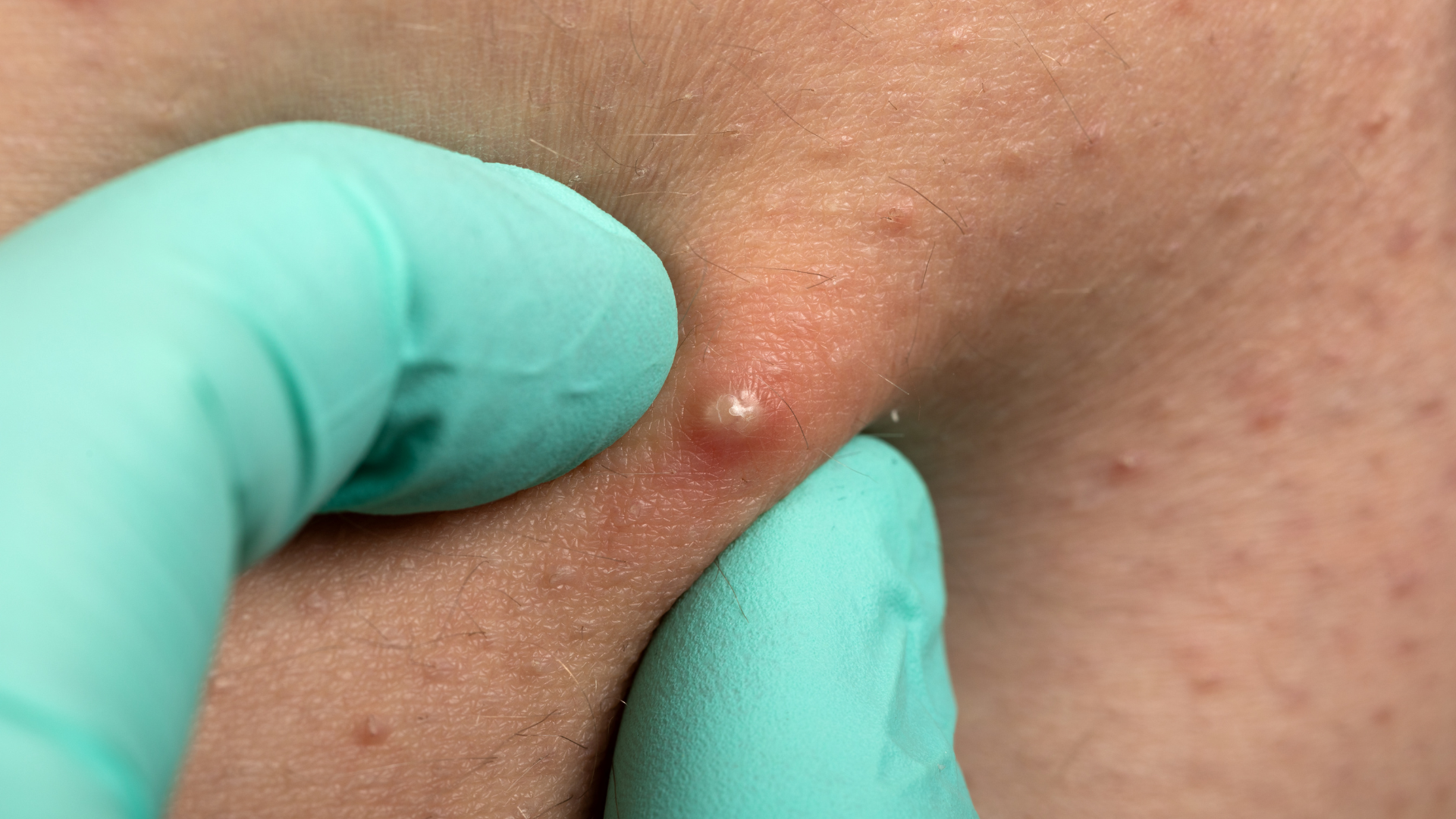 Viêm nang lông do vi khuẩn có thể biểu hiện mụn mủ