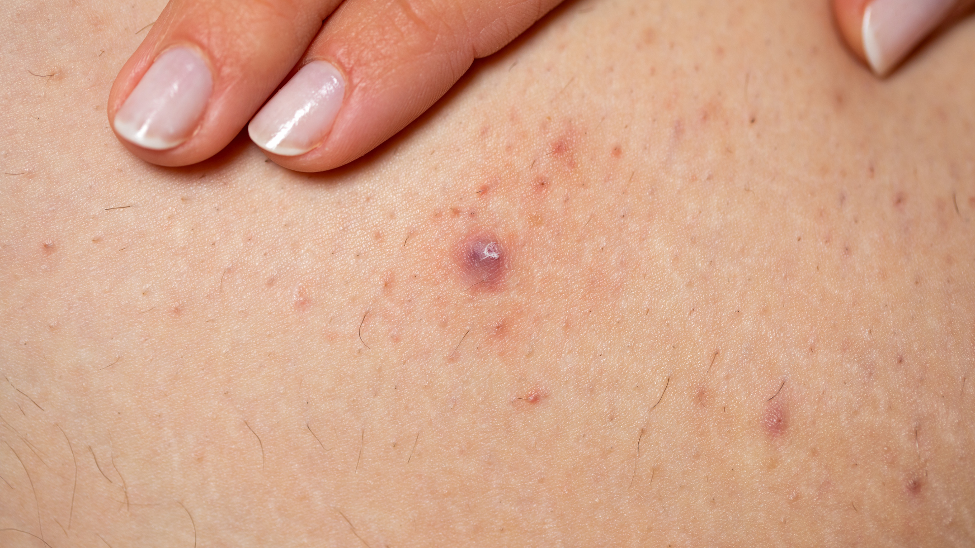 Người bệnh nên đi khám sớm nếu có bệnh lý nền mạn tính