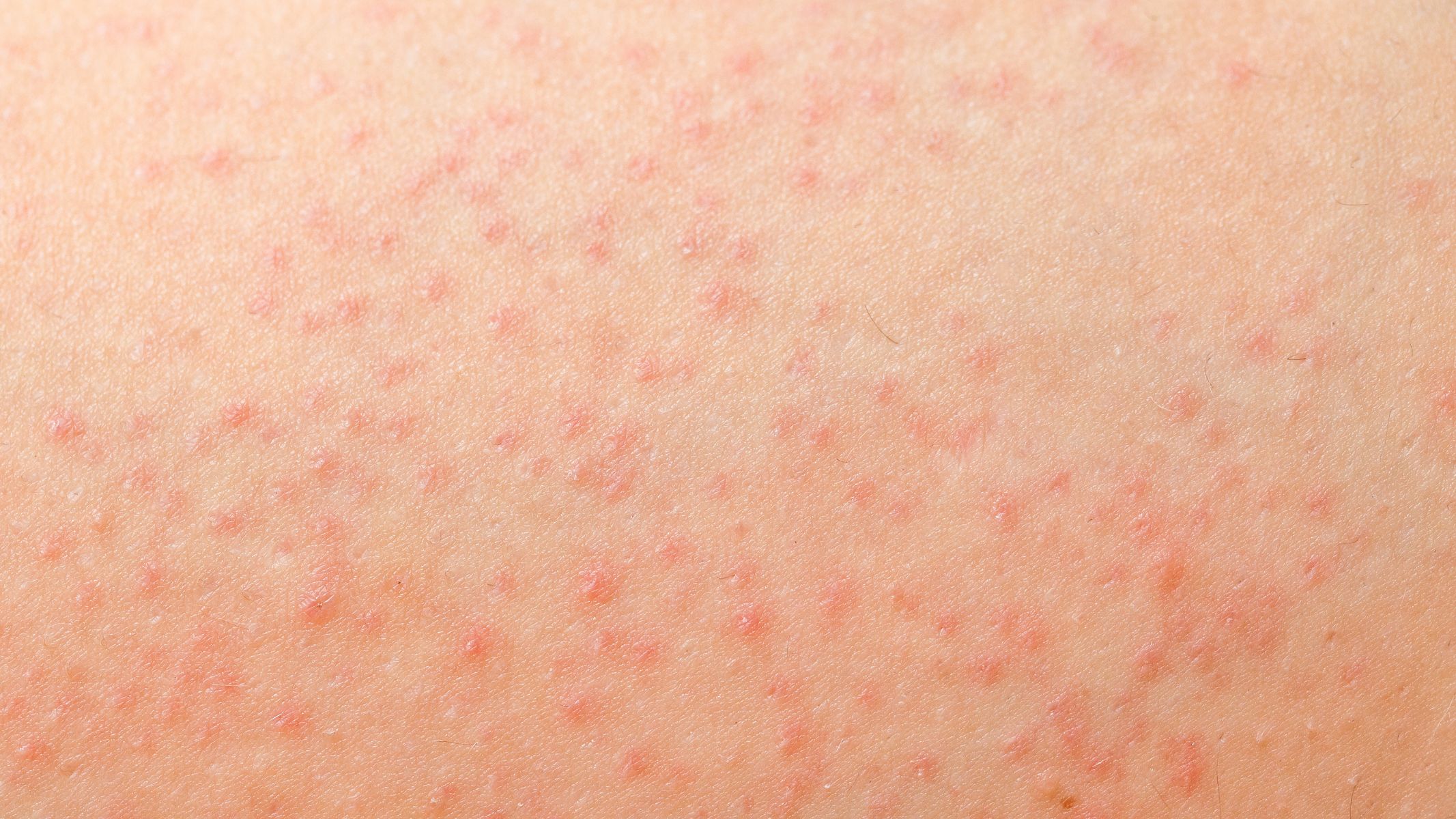 Viêm nang lông bao lâu thì khỏi?