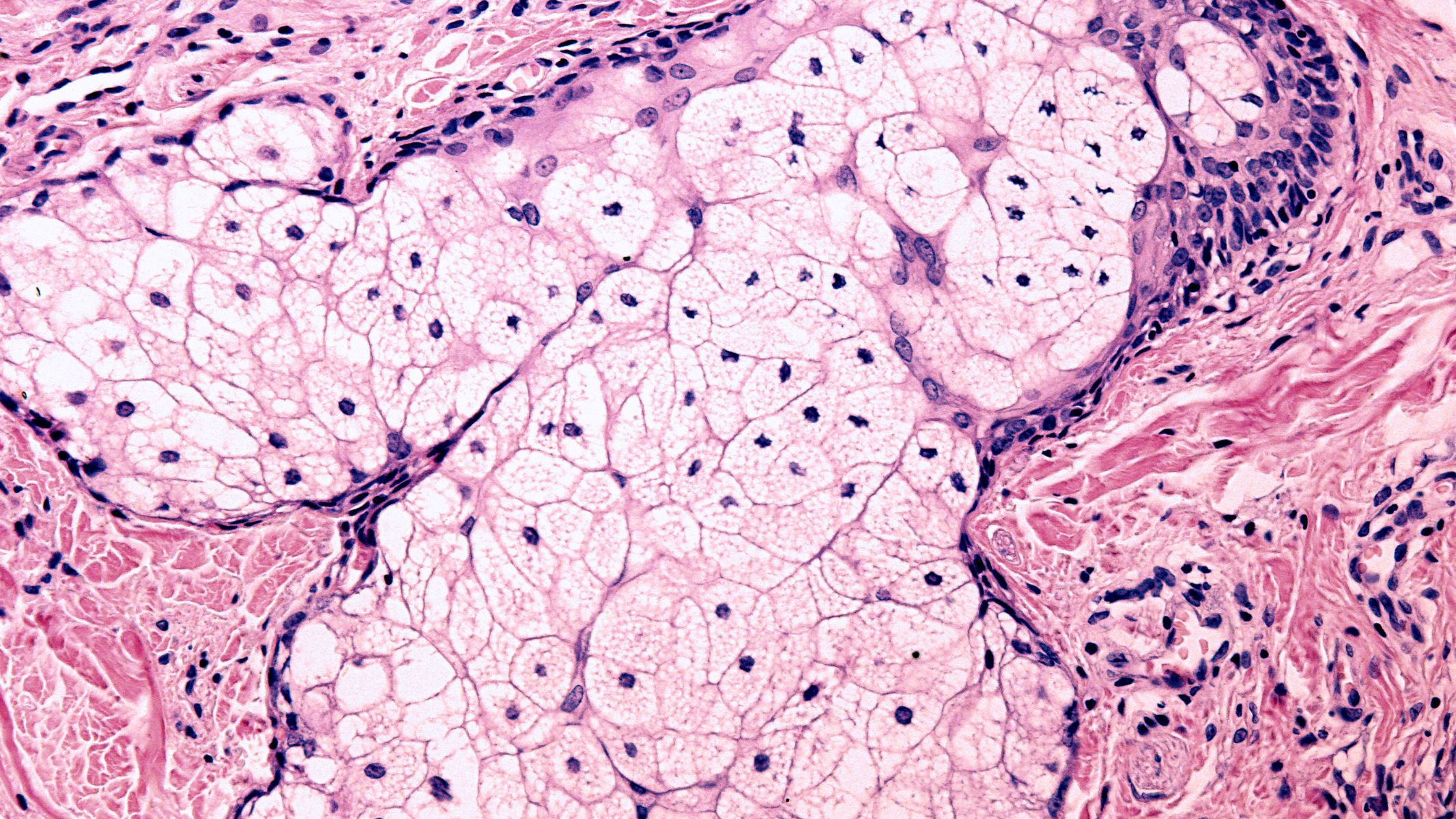 Tuyến bã nhờn hoạt động quá mức khiến lượng dầu thừa và tế bào chết tích tụ, làm bít tắc nang lông và tạo điều kiện cho vi khuẩn, nấm phát triển
