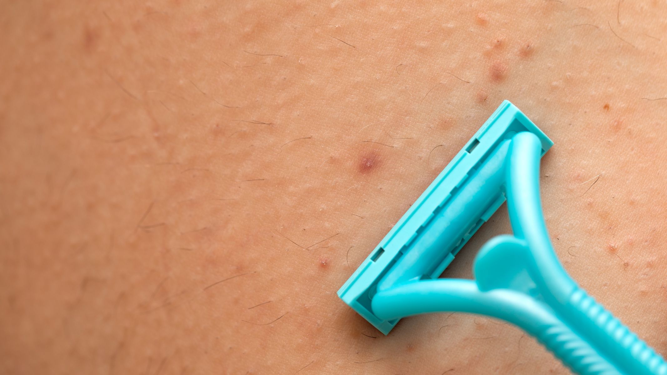 Cạo hoặc nhổ lông thường xuyên đều có thể làm tổn thương da, gây viêm tái phát