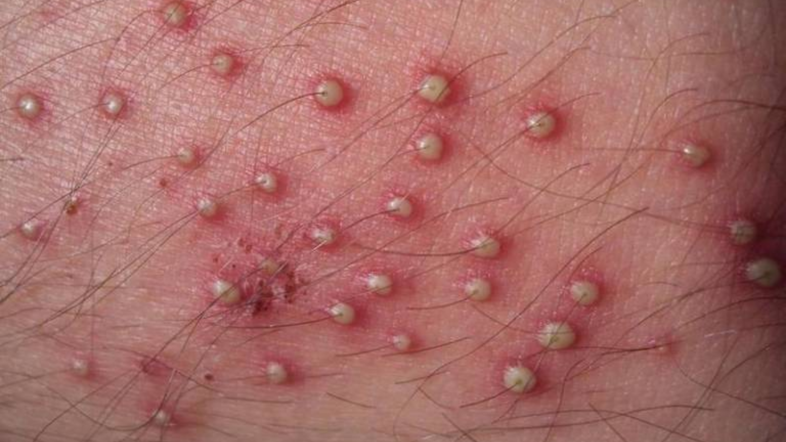 Viêm nang lông hồng ban hình mạng lưới: Những thông tin quan trọng cần biết 3