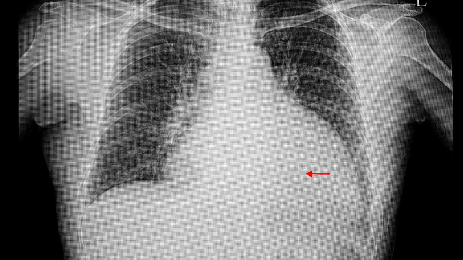 Viêm phổi có di truyền không? Tìm hiểu yếu tố nguy cơ di truyền và cách phòng ngừa 1