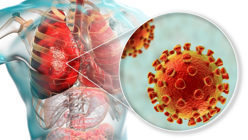 Viêm phổi do bội nhiễm là bệnh hô hấp nặng, dễ gây suy hô hấp nếu không điều trị sớm