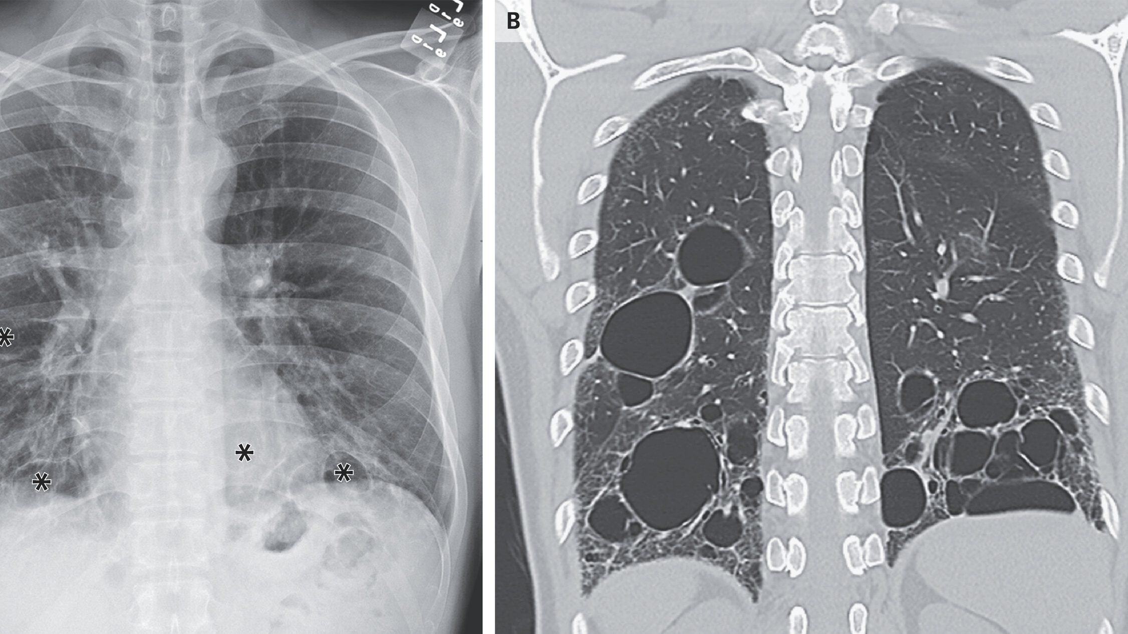 Chụp X-quang ngực hoặc chụp CT để có cái nhìn rõ hơn và giúp chẩn đoán viêm phổi kẽ