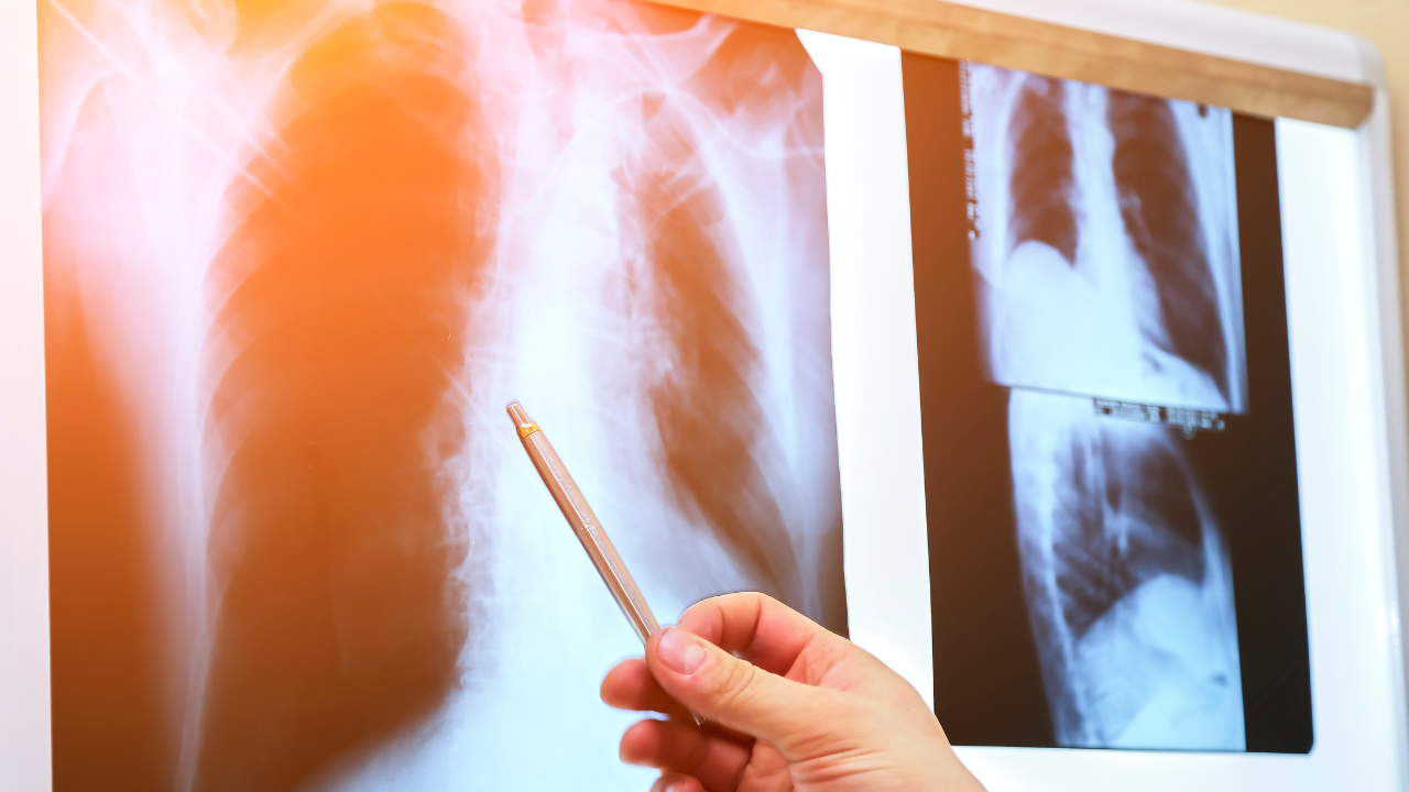 viem-phoi-trieu-chung-nguyen-nhan-va-cach-dieu-tri (1).png