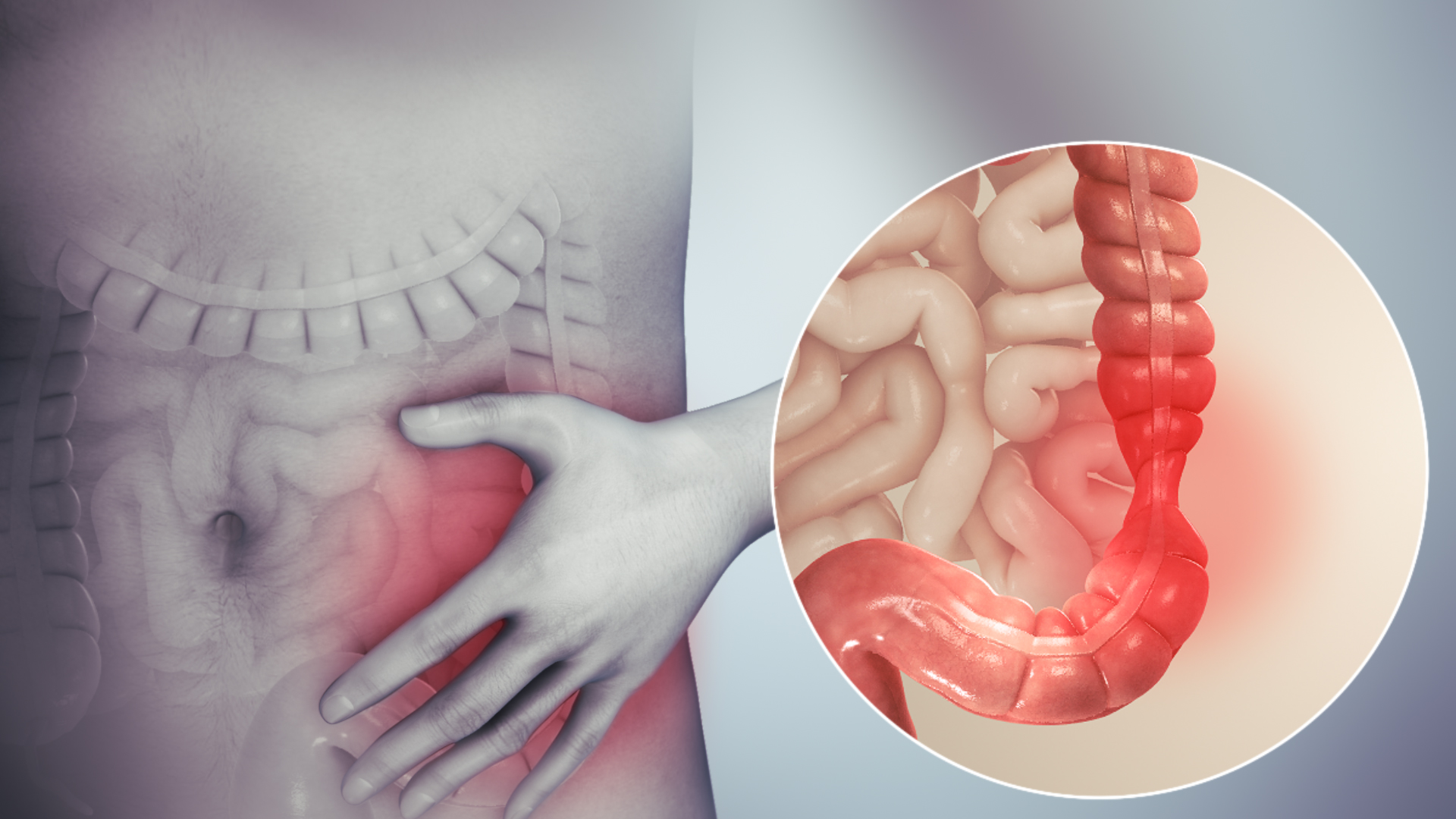 Viêm phúc mạc ruột thừa là gì? Bệnh lý nguy hiểm cần phát hiện sớm 1.jpg