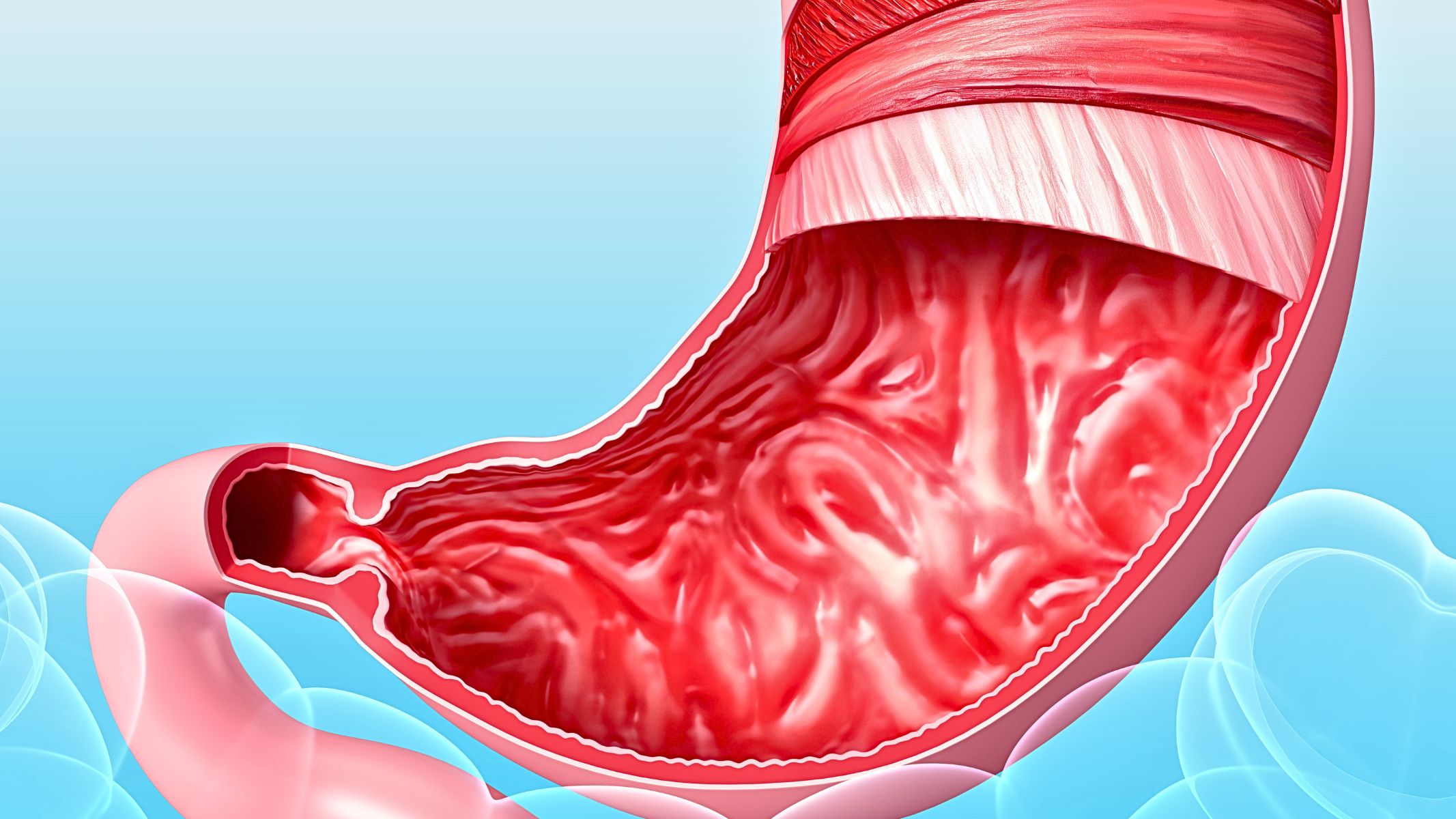 Viêm trợt hang vị dạ dày là gì?