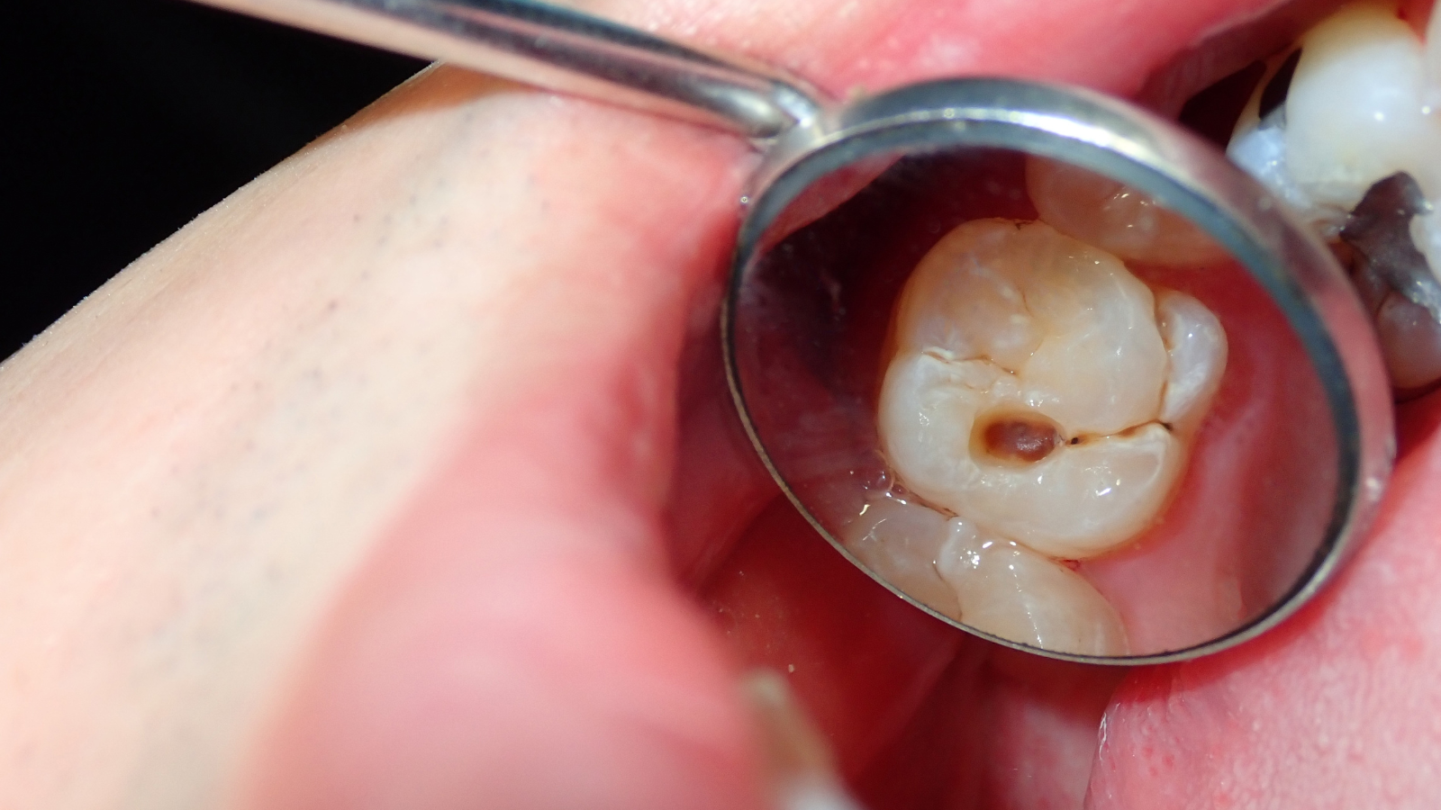 Sâu răng tiến triển là nguyên nhân gây bệnh