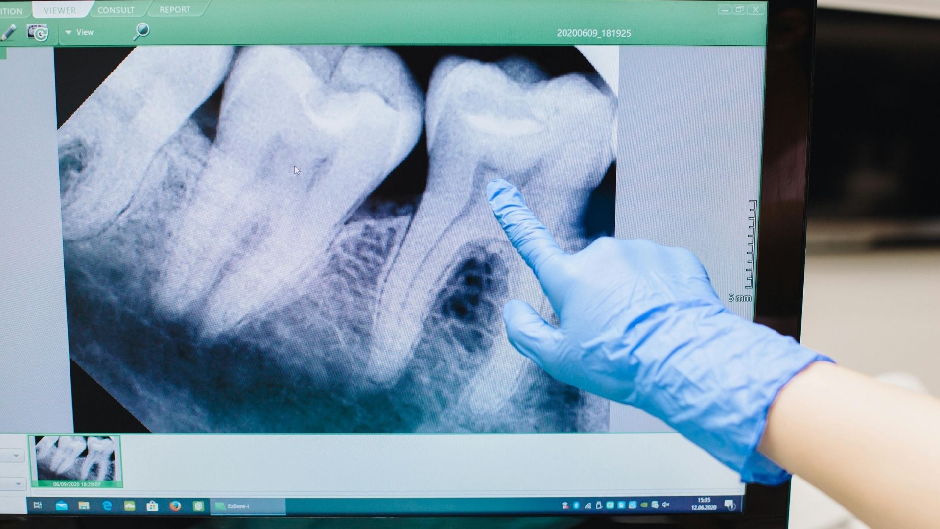 Sâu răng tiến triển có thể gây viêm tủy răng ở trẻ em