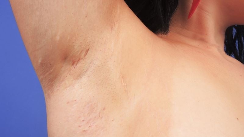 Viêm tuyến mồ hôi mủ là bệnh da liễu mạn tính thường xuất hiện dưới vùng nách, kẽ mông,...