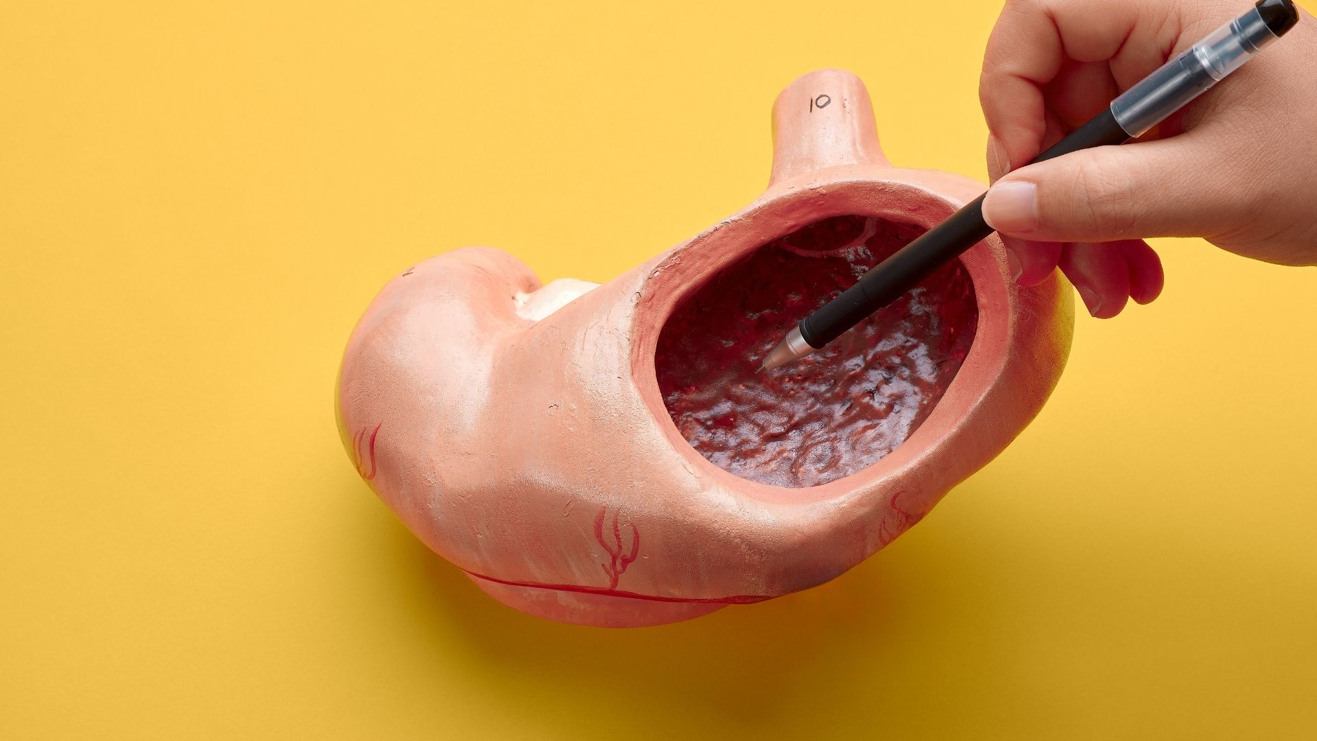 Ung thư dạ dày là biến chứng nguy hiểm cần điều trị sớm