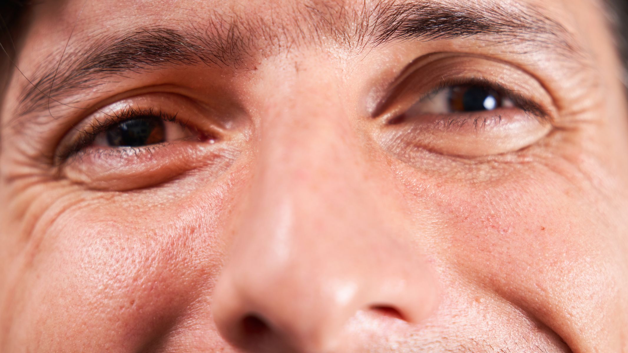 Khi viễn thị nặng kéo dài, mắt phải điều tiết quá mức để nhìn rõ, gây lác trong