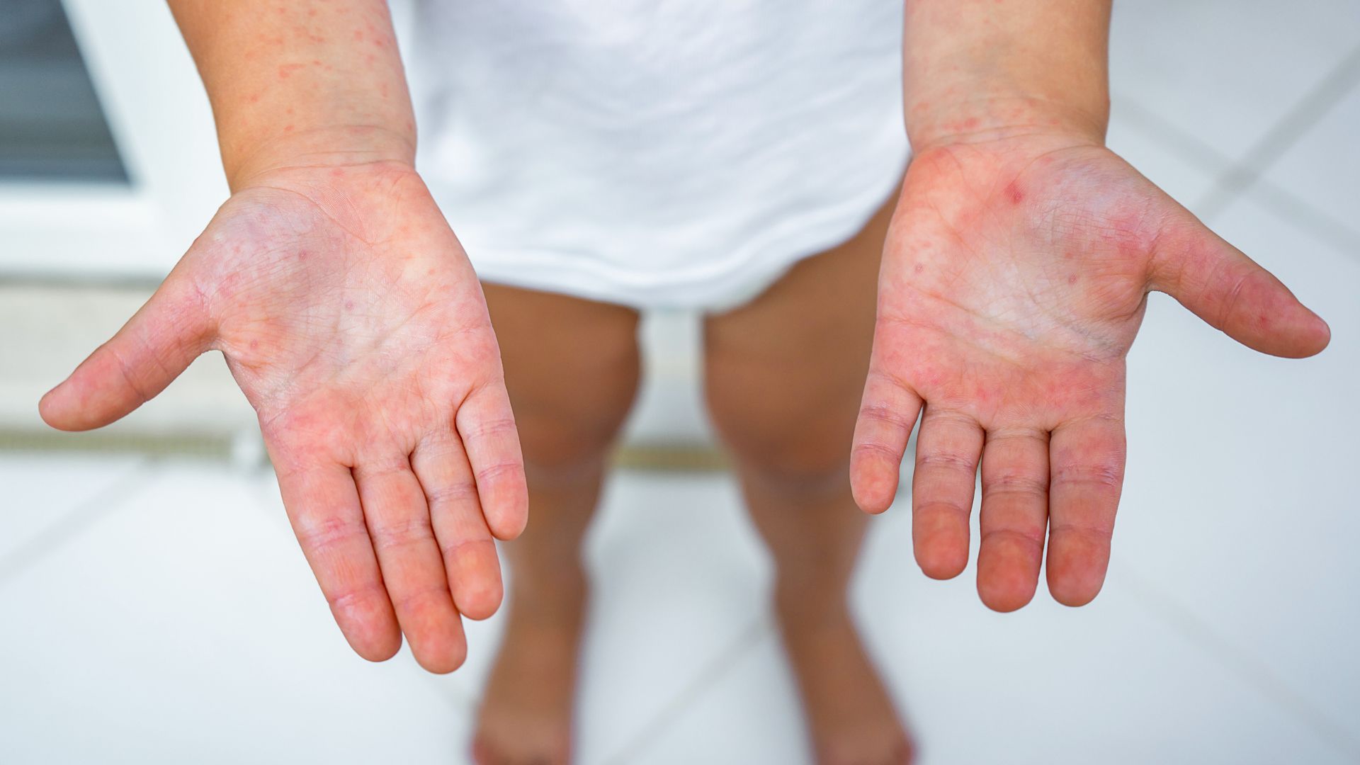 Bệnh do EV71 có thể chuyển nặng rất nhanh, từ nhẹ sang nghiêm trọng