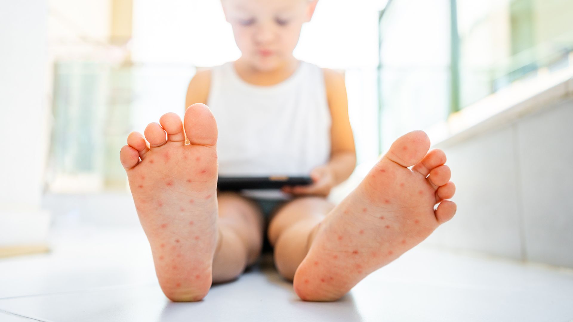 Chuyên gia khuyến cáo không chủ quan với bệnh, cần theo dõi sát triệu chứng