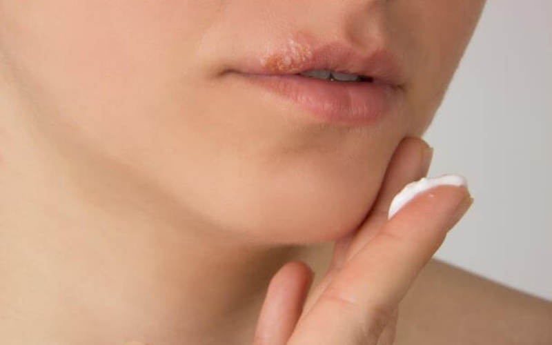 virus-herpes-gay-ra-benh-gi-dau-hieu-nhan-biet-va-cach-dieu-tri-1