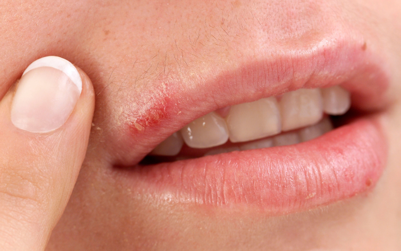 virus-herpes-gay-ra-benh-gi-dau-hieu-nhan-biet-va-cach-dieu-tri-4