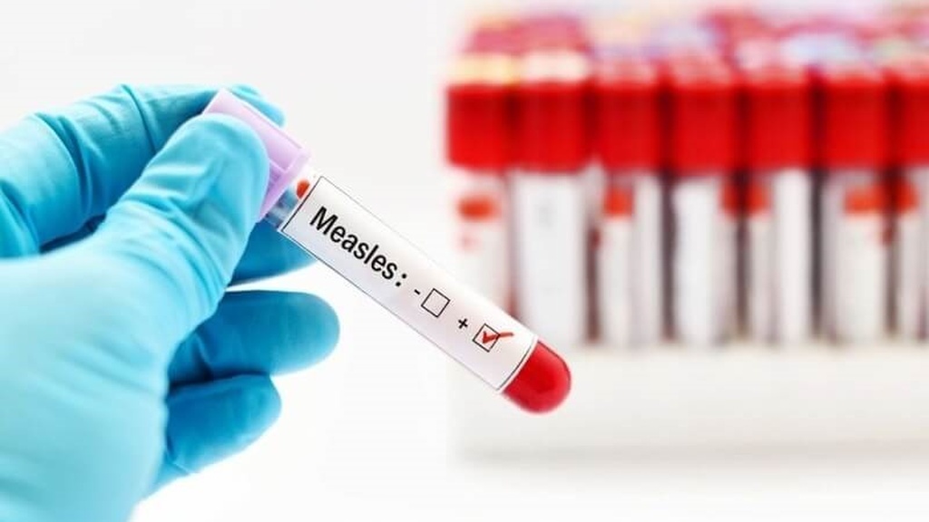 virus-soi-va-tat-tan-tat-nhung-thong-tin-ban-can-biet 4.jpg