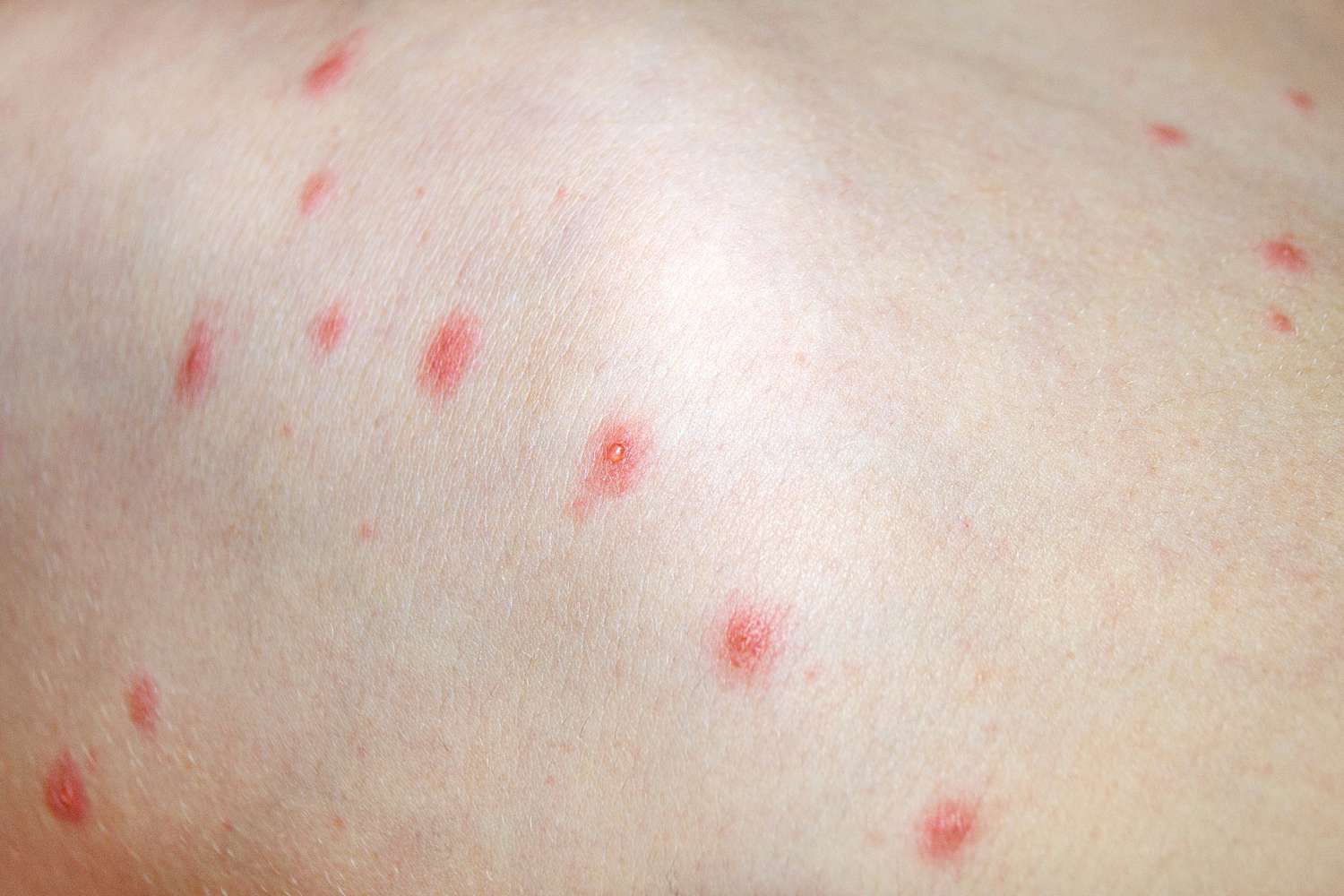 virus-zona-trieu-chung-va-cach-phong-ngua 3.jpg