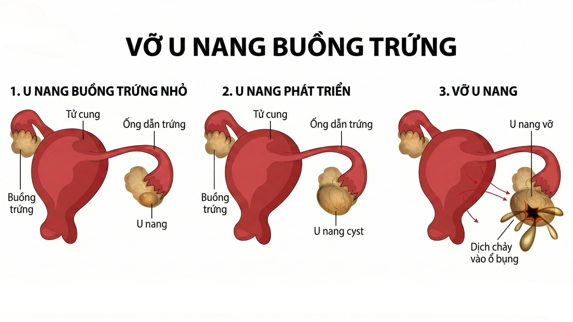 Nhận biết sớm vỡ nang buồng trứng qua cơn đau bụng dưới