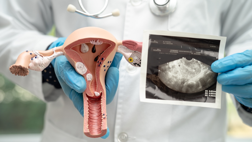 Rối loạn phóng noãn do PCOS là nguyên nhân phổ biến gây vô sinh nguyên phát ở nữ