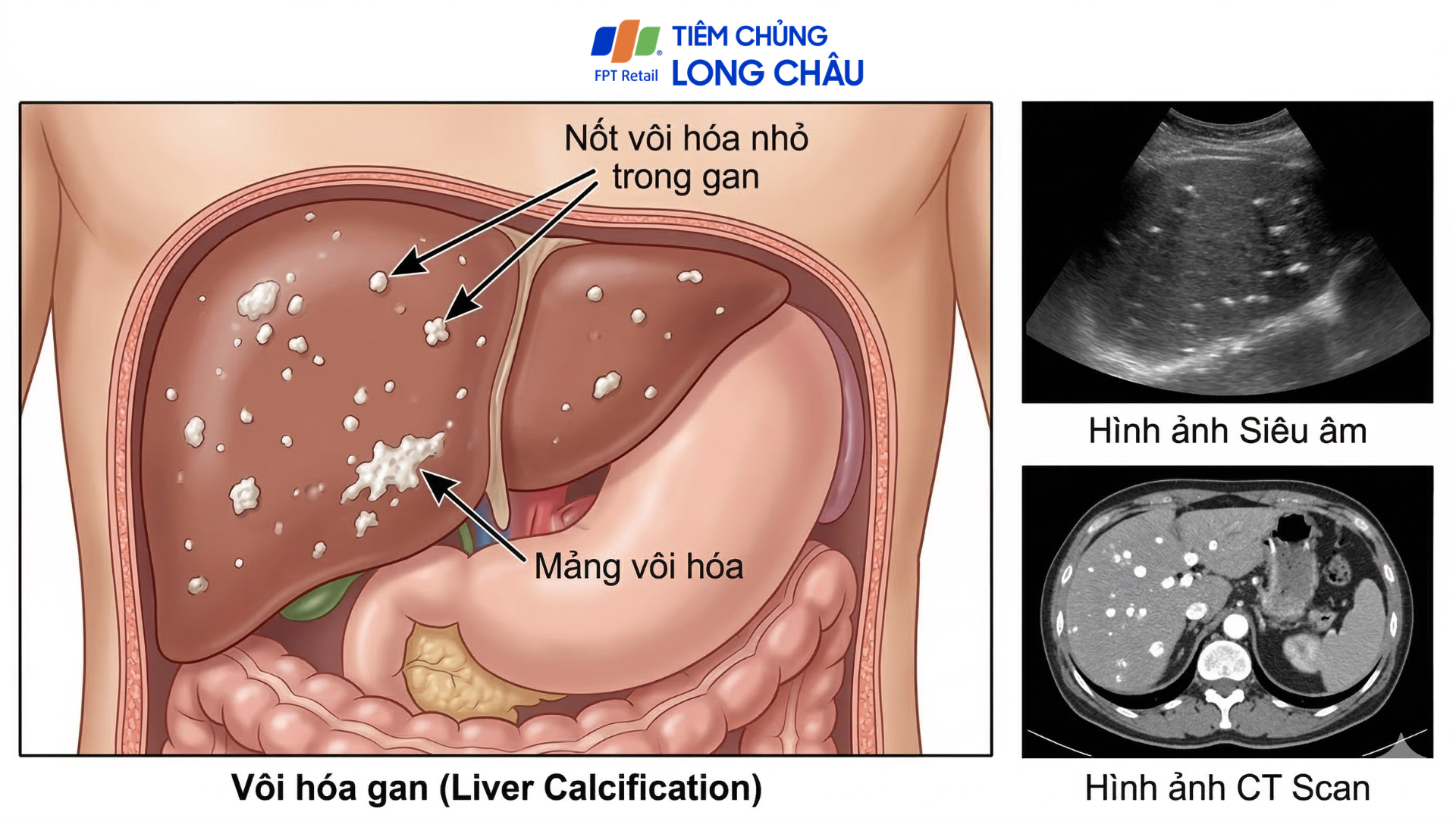 Vôi hóa trong gan thường xuất hiện khi mô gan từng bị viêm hoặc tổn thương
