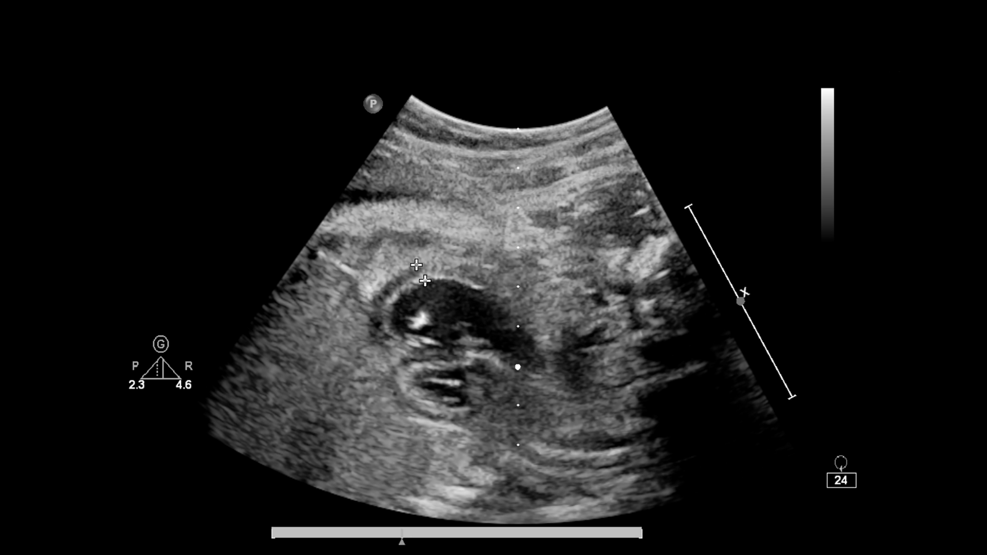 Chẩn đoán vôi hoá gan thường dựa vào siêu âm hoặc CT