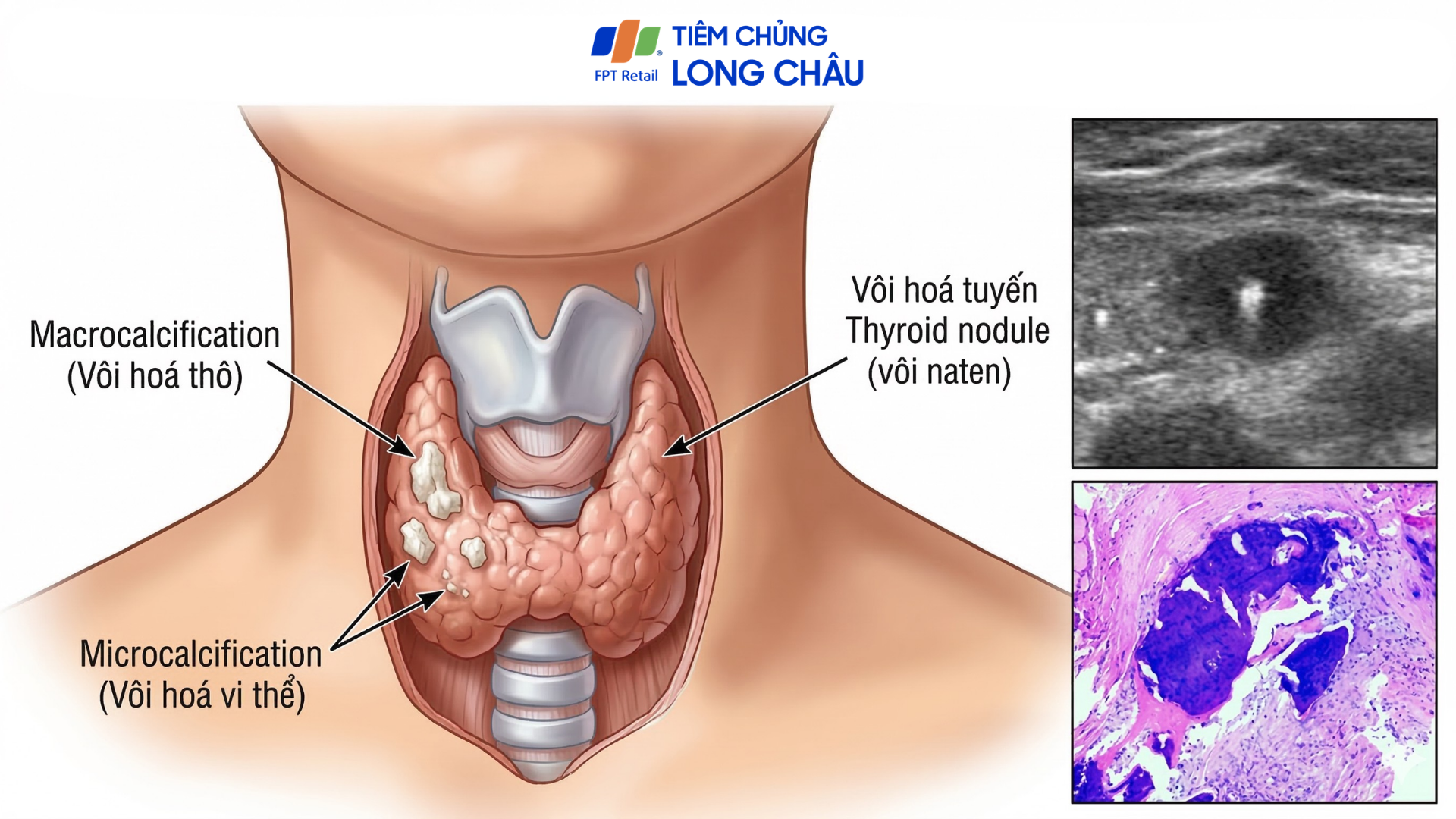 Vị trí vôi hoá tuyến giáp trong cấu trúc tuyến giáp
