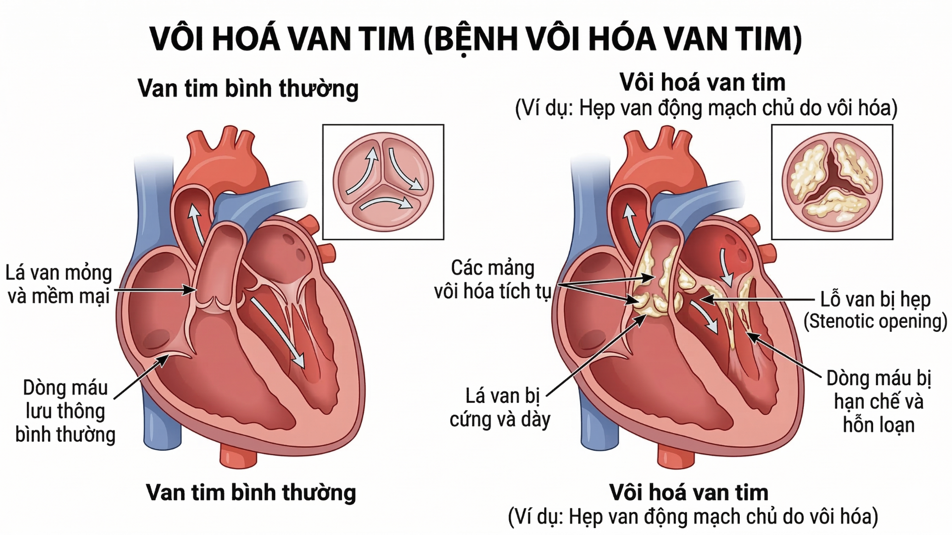 Vôi hoá van tim xảy ra khi canxi tích tụ trên lá van