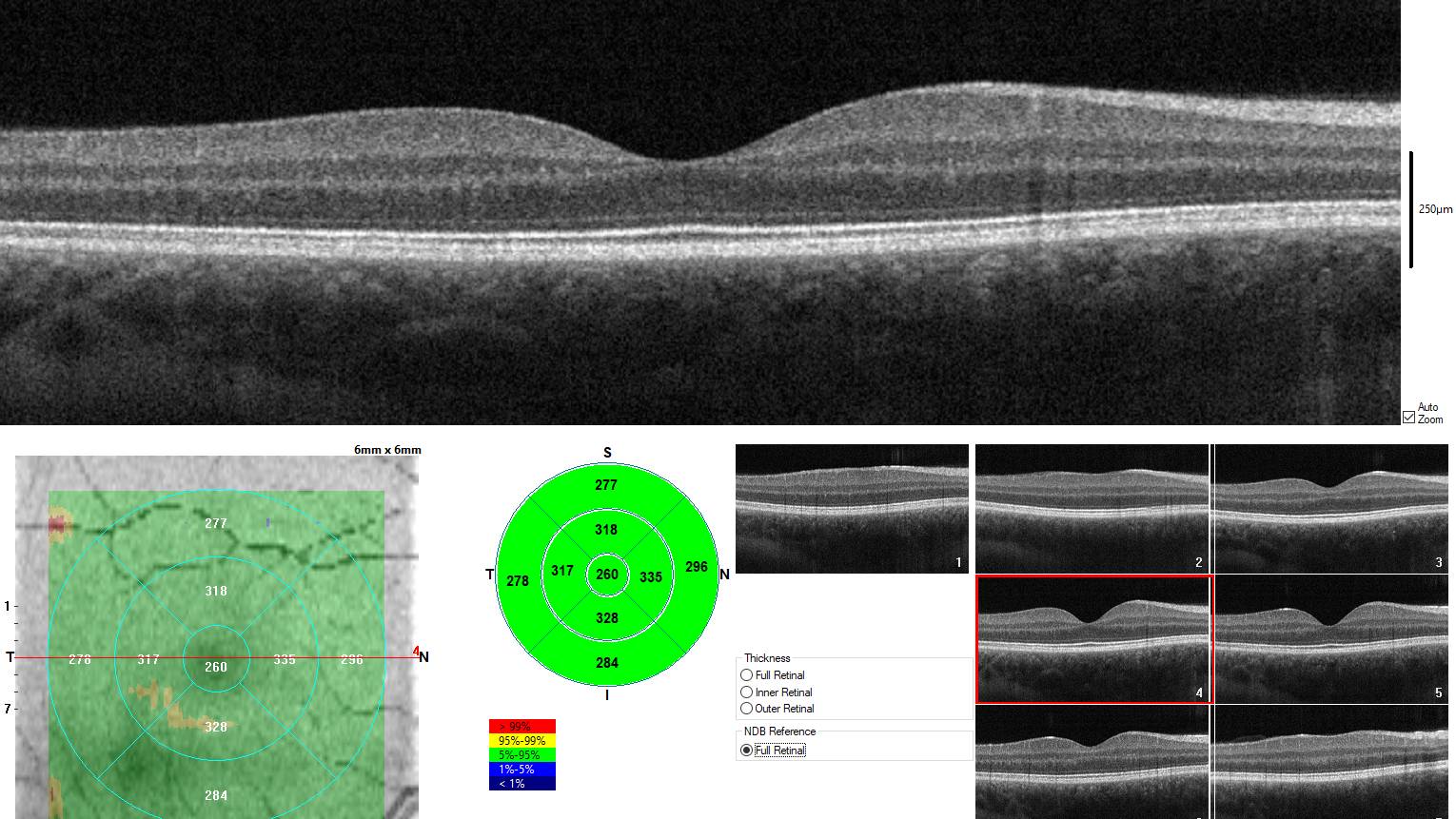 Chụp OCT giúp bác sĩ đánh giá tiến triển bệnh và hiệu quả điều trị theo thời gian