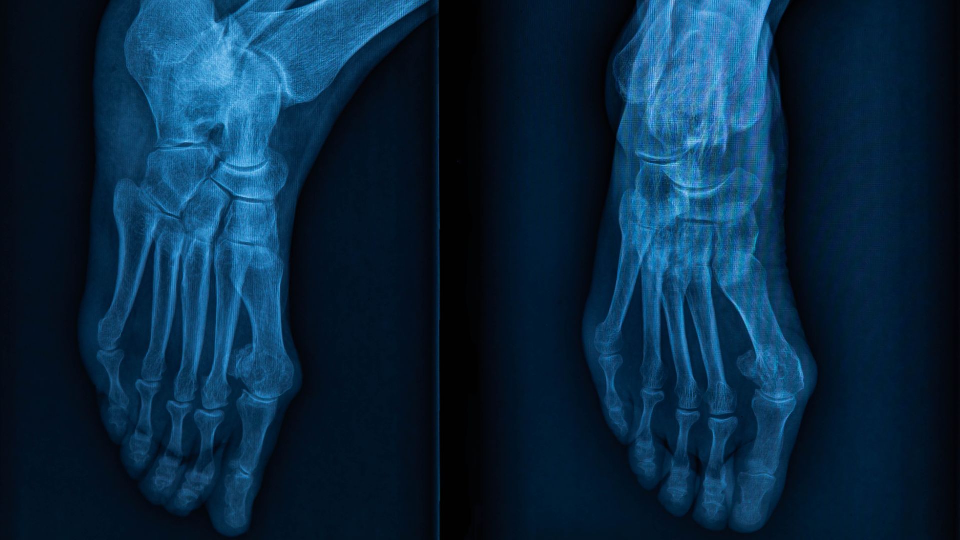 X-quang bàn chân chủ yếu đánh giá tổn thương xương