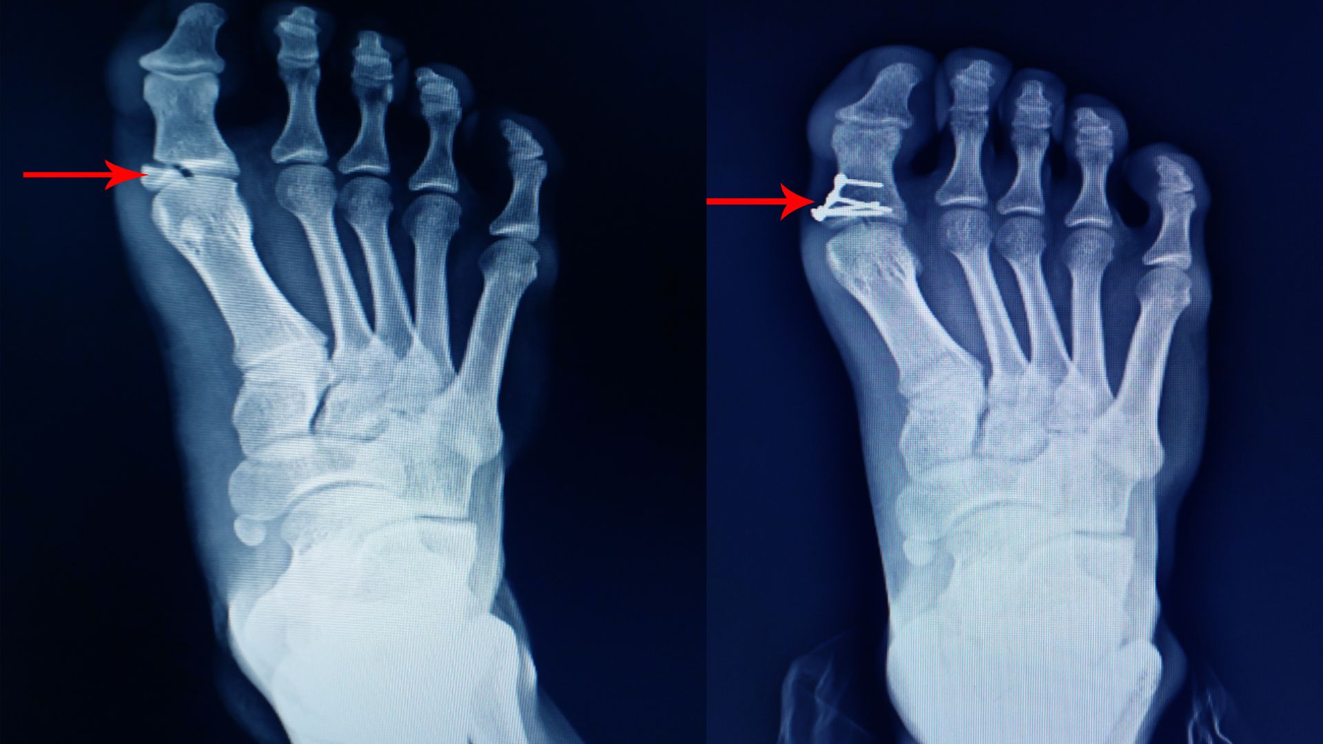 Ưu điểm và hạn chế của phương pháp chụp X-quang bàn chân