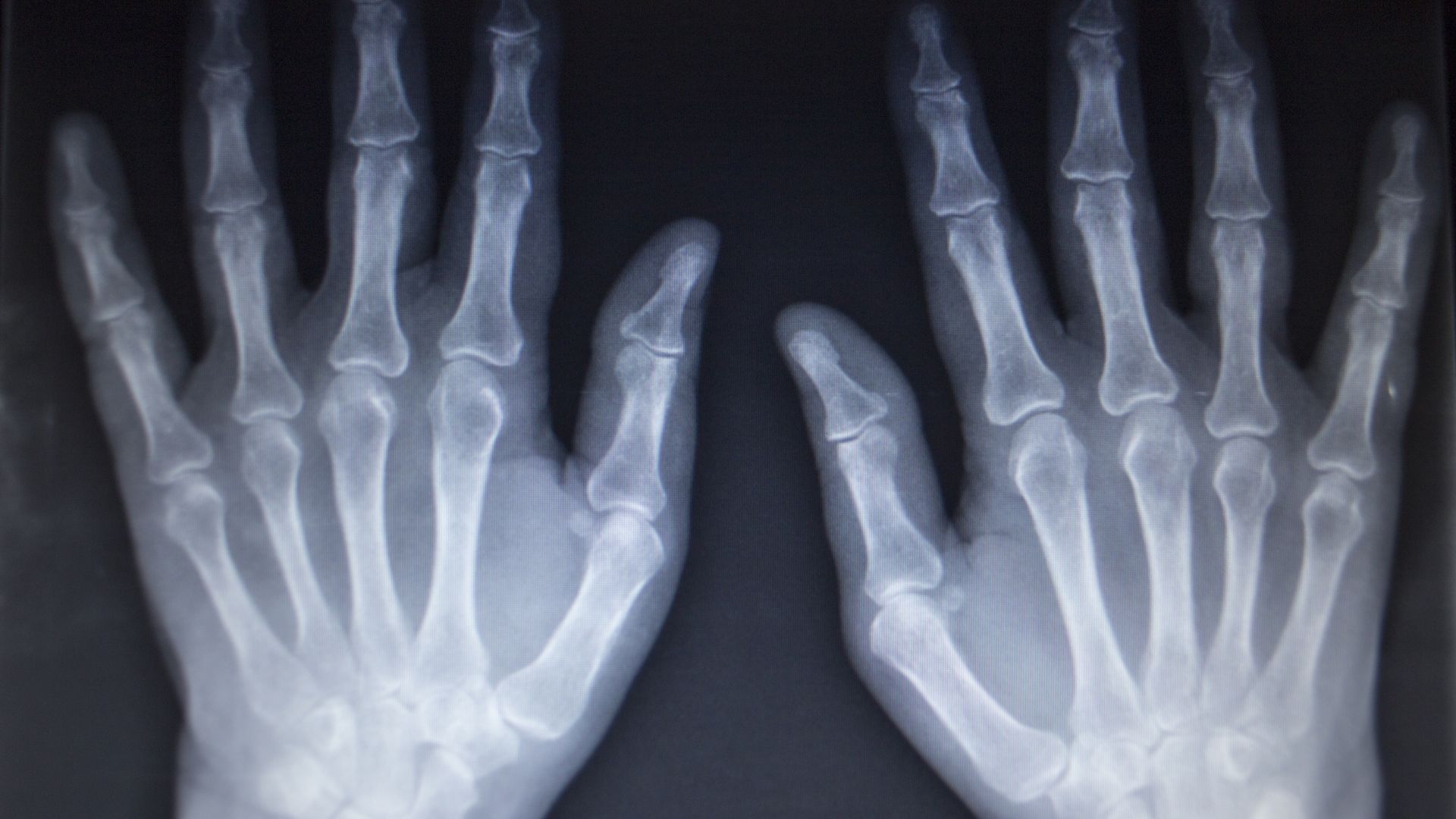 Nguyên lý chụp X-quang bàn tay