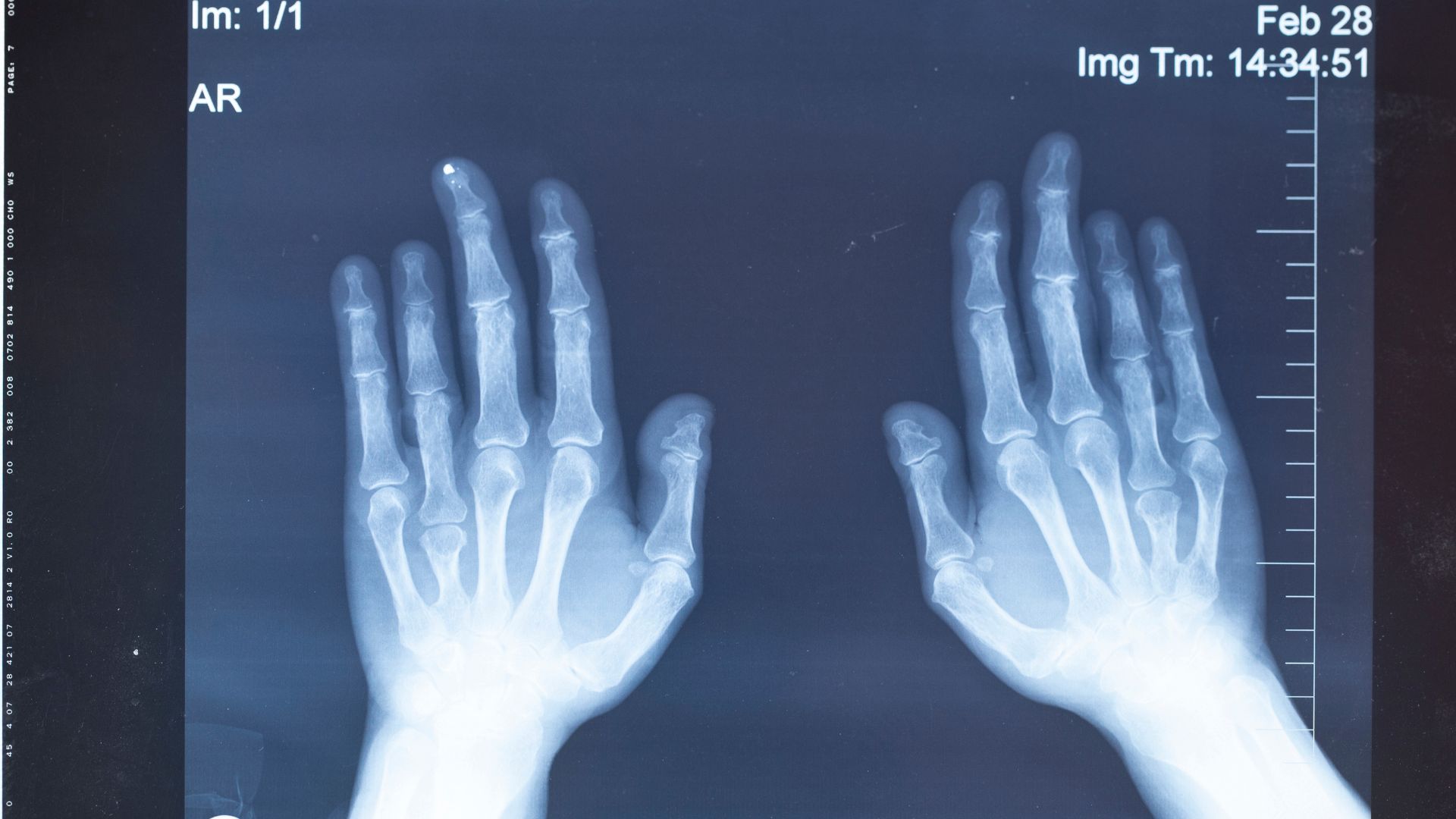 Ưu điểm và hạn chế khi chụp X-quang bàn tay