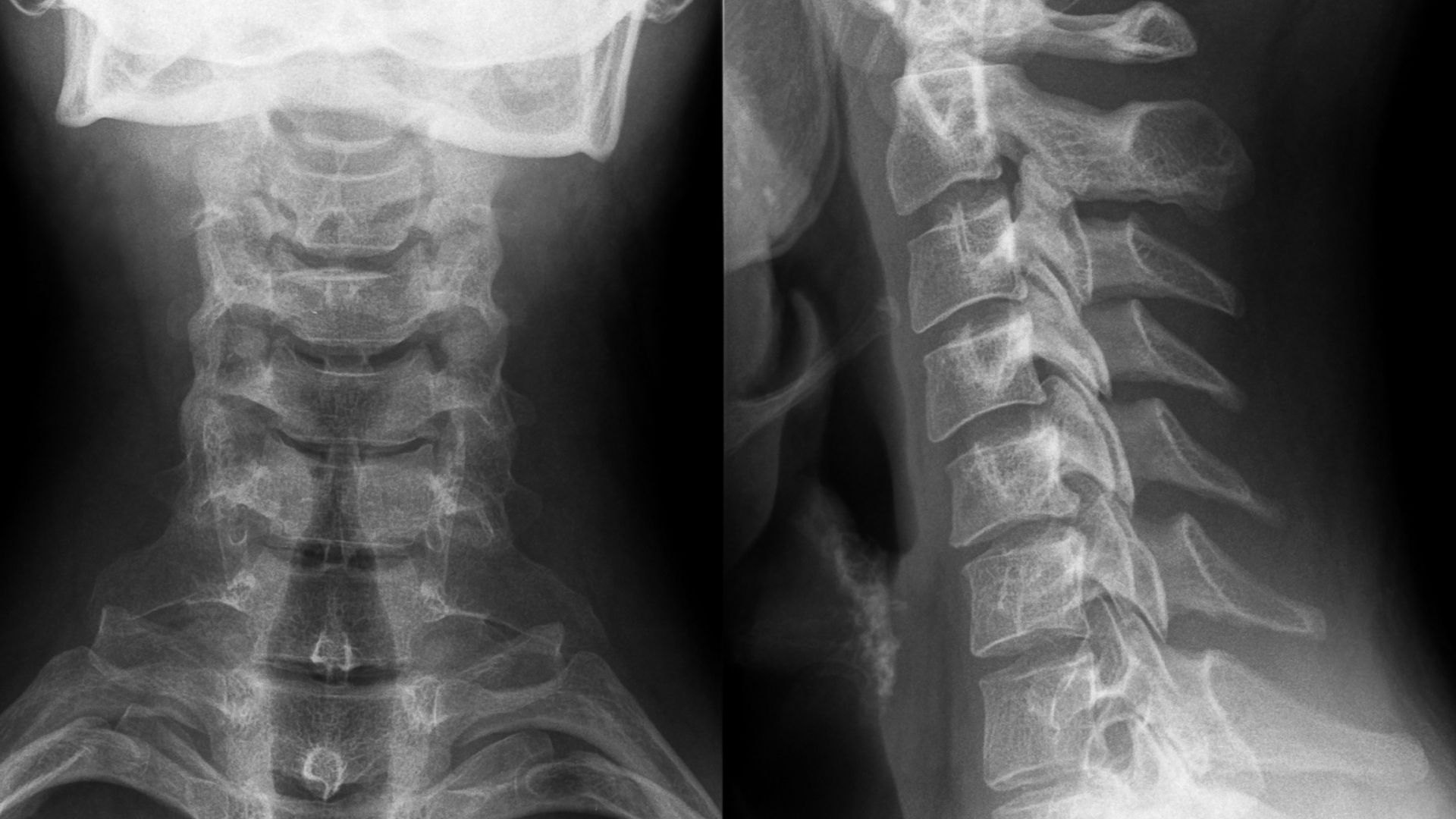 X-quang cột sống cổ phát hiện các tổn thương liên quan đến cấu trúc xương