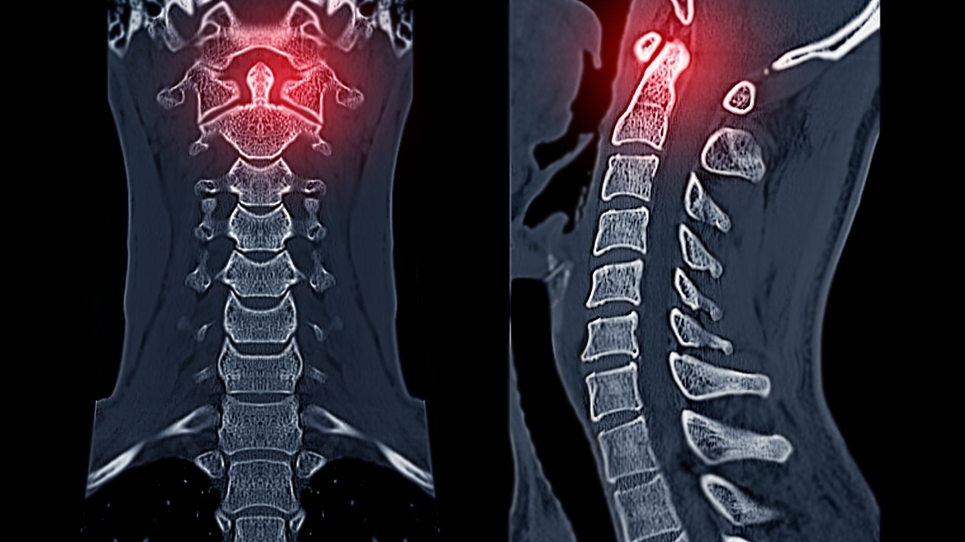 CT Scan cột sống cổ hữu ích trong các trường hợp chấn thương phức tạp