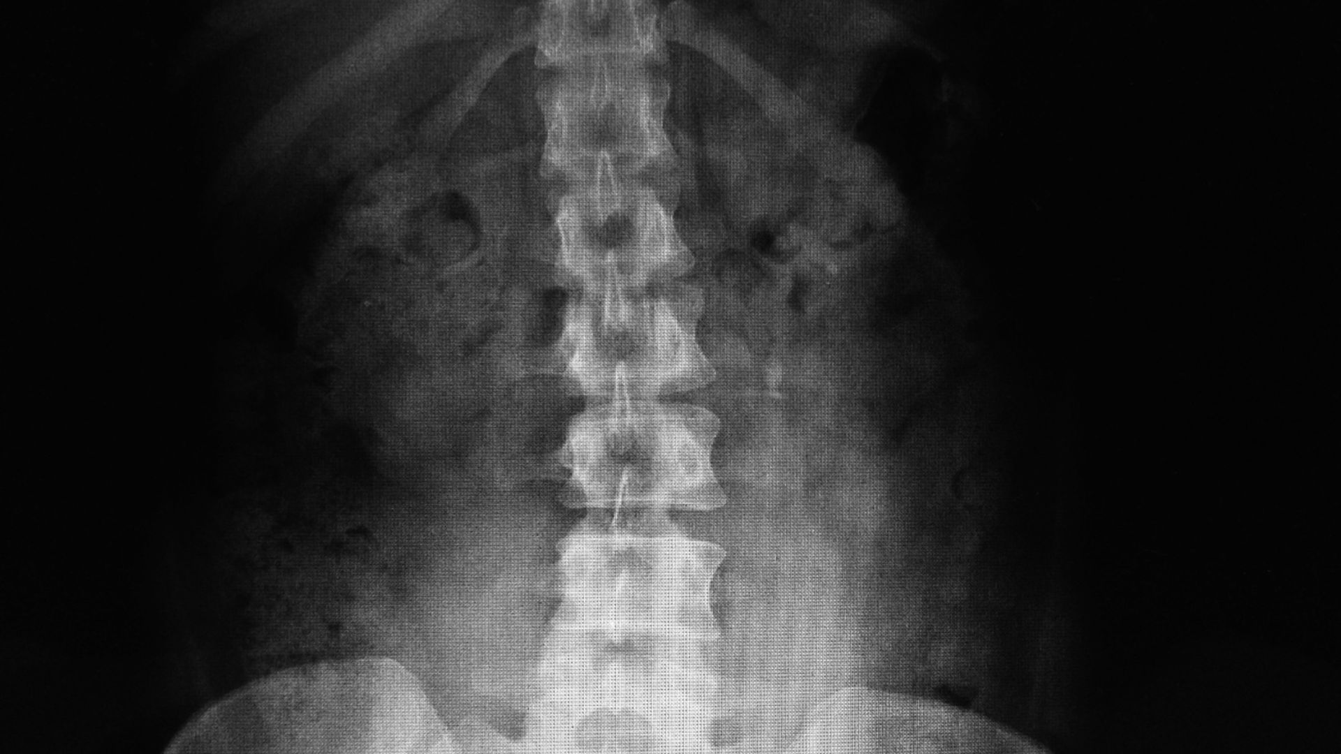 X-quang cột sống thắt lưng là kỹ thuật sử dụng tia X để tạo hình ảnh các đốt sống từ L1 đến L5