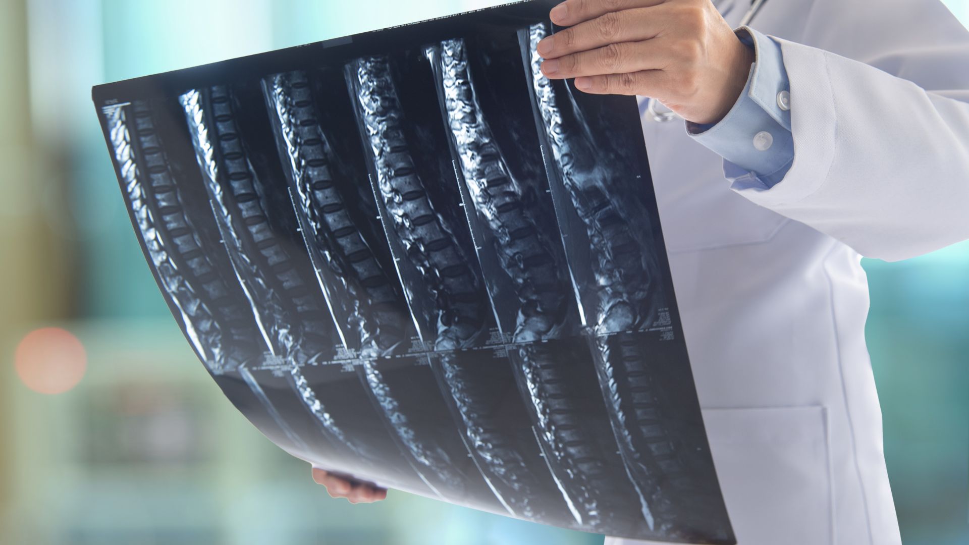 X-quang cột sống thắt lưng hỗ trợ bác sĩ phát hiện các bệnh lý cột sống