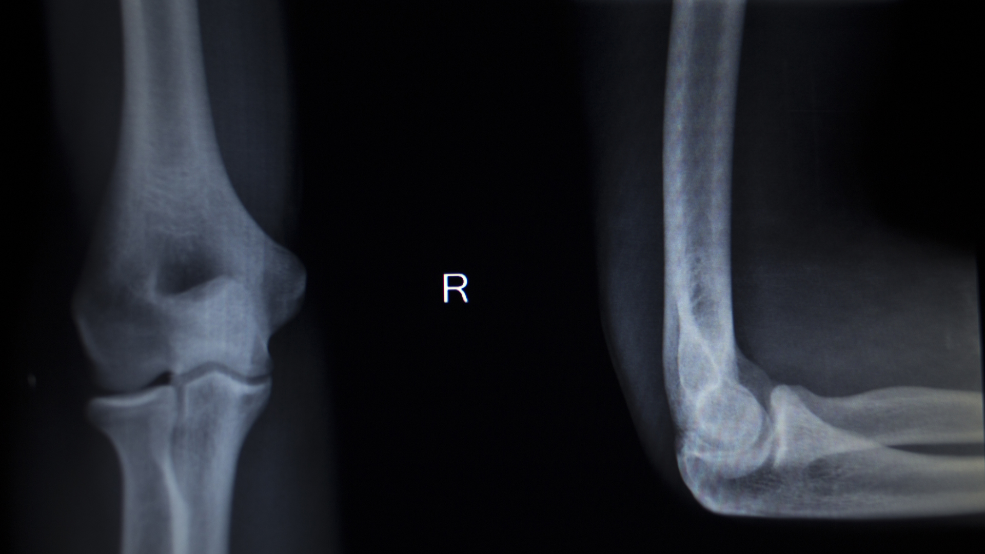 Dấu hiệu cần chụp X-quang khớp khuỷu để kiểm tra tổn thương